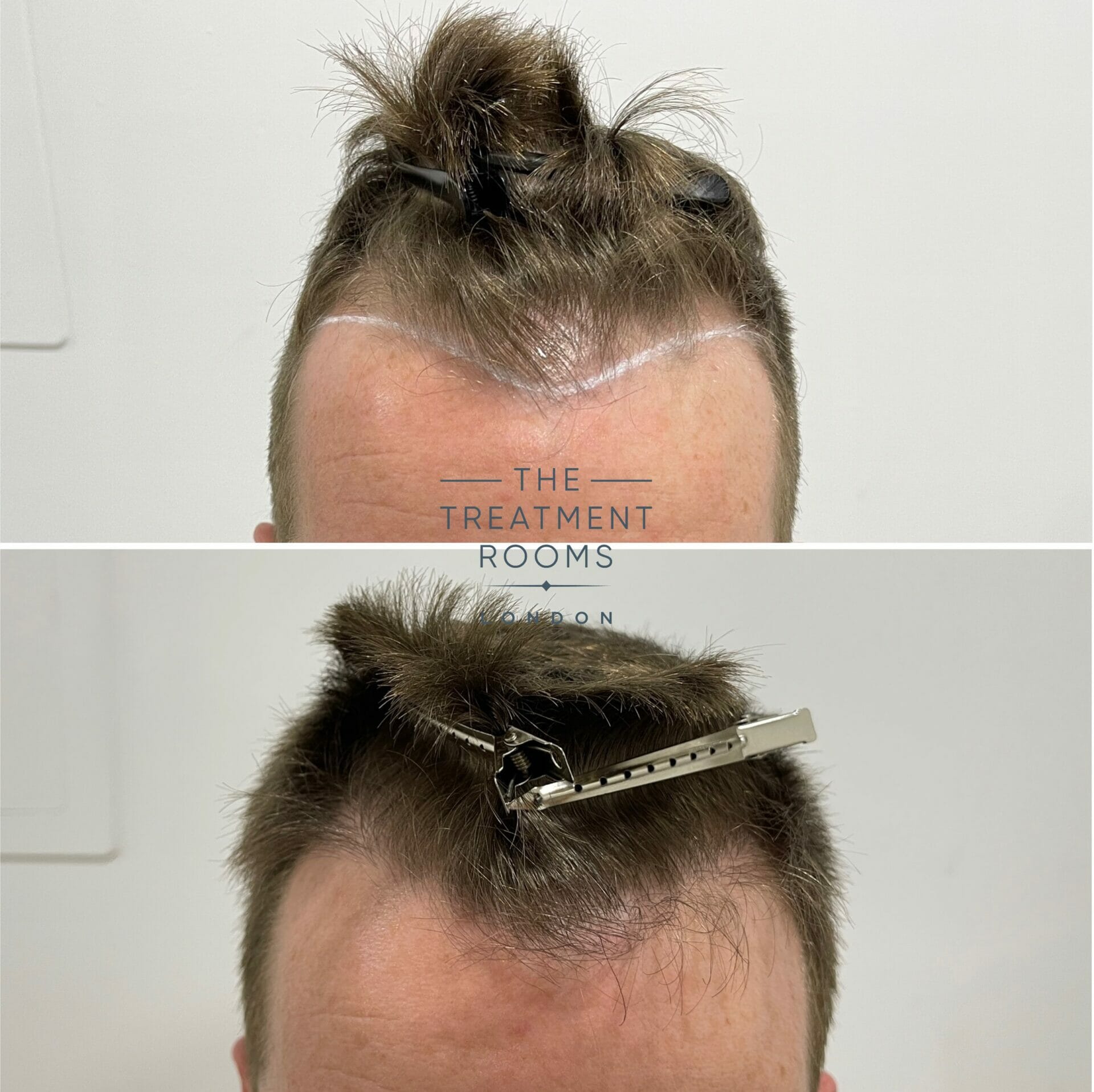 hairline hair transplant before and after