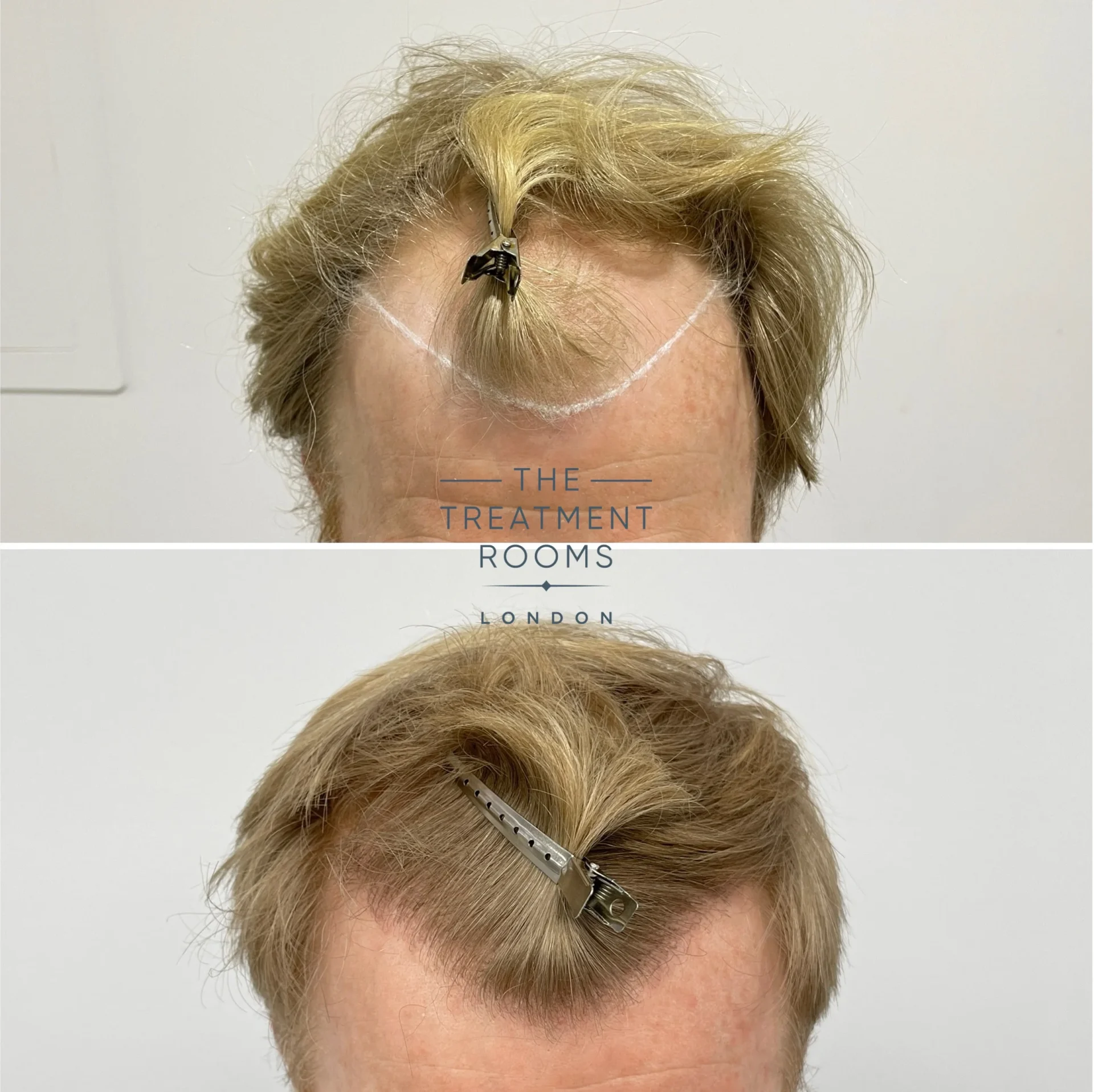 hairline hair transplant before and after