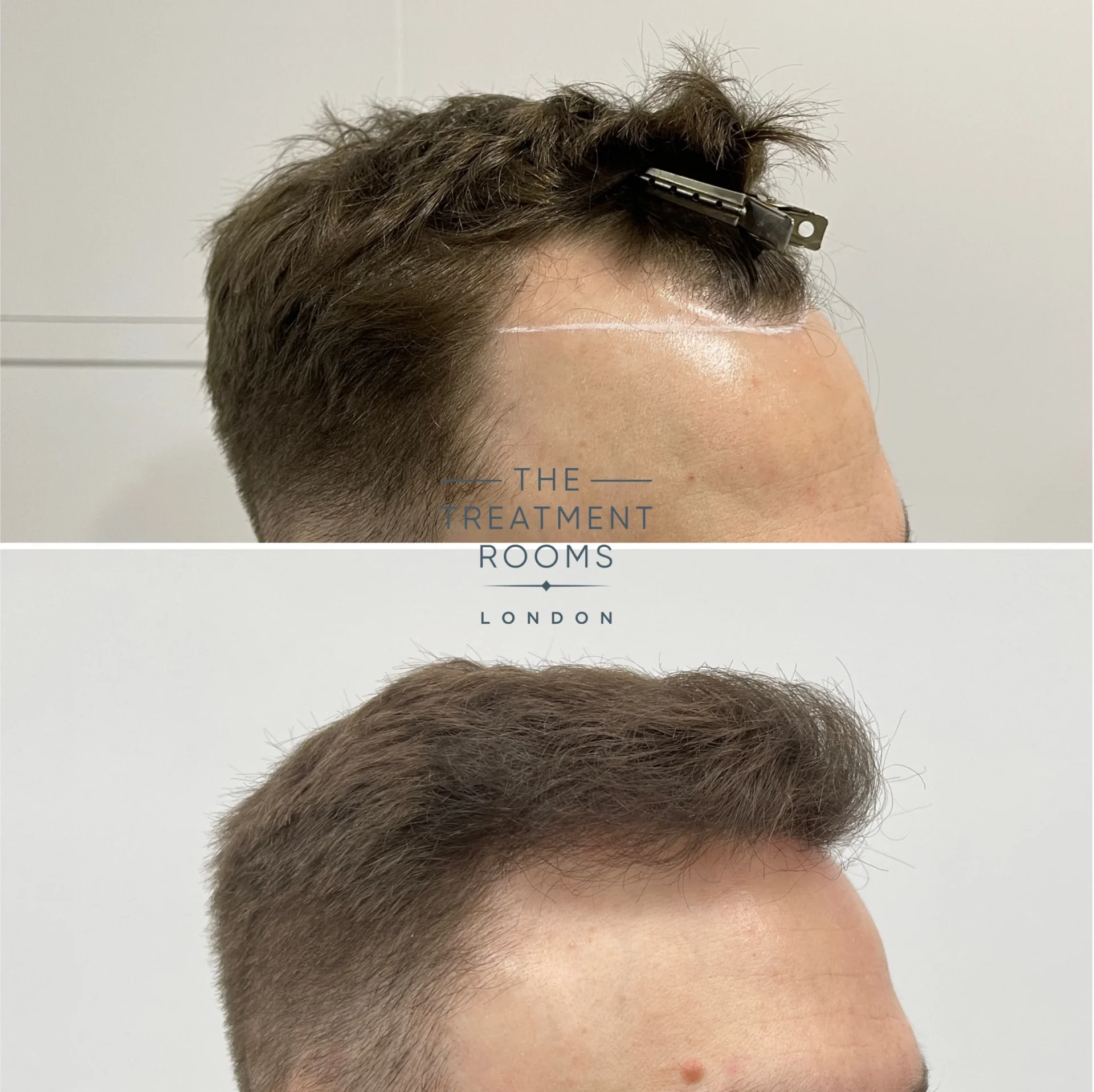 hairline hair transplant clinic london 1314 grafts before and after