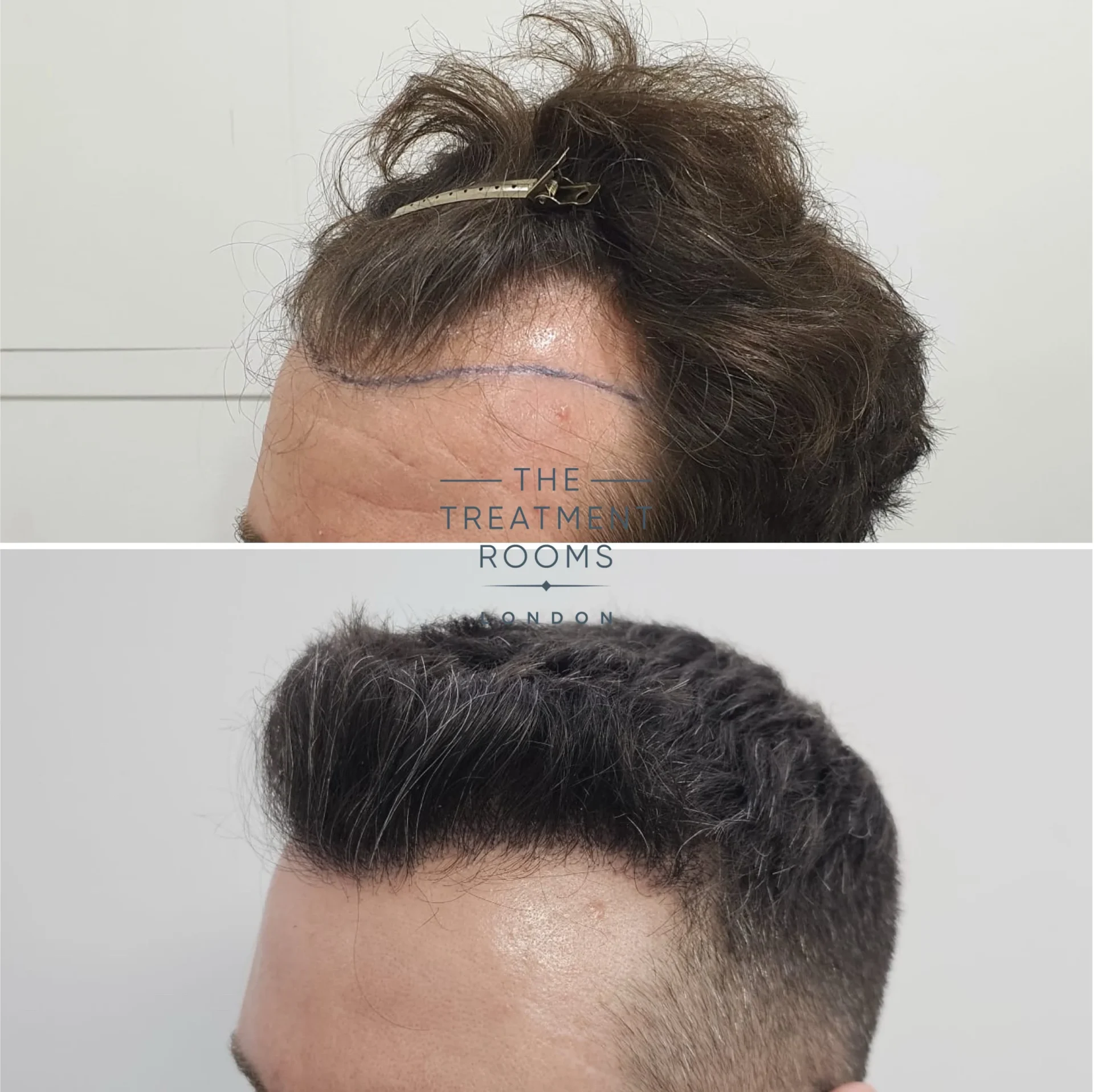 hairline hair transplant clinic london 1745 grafts before and after