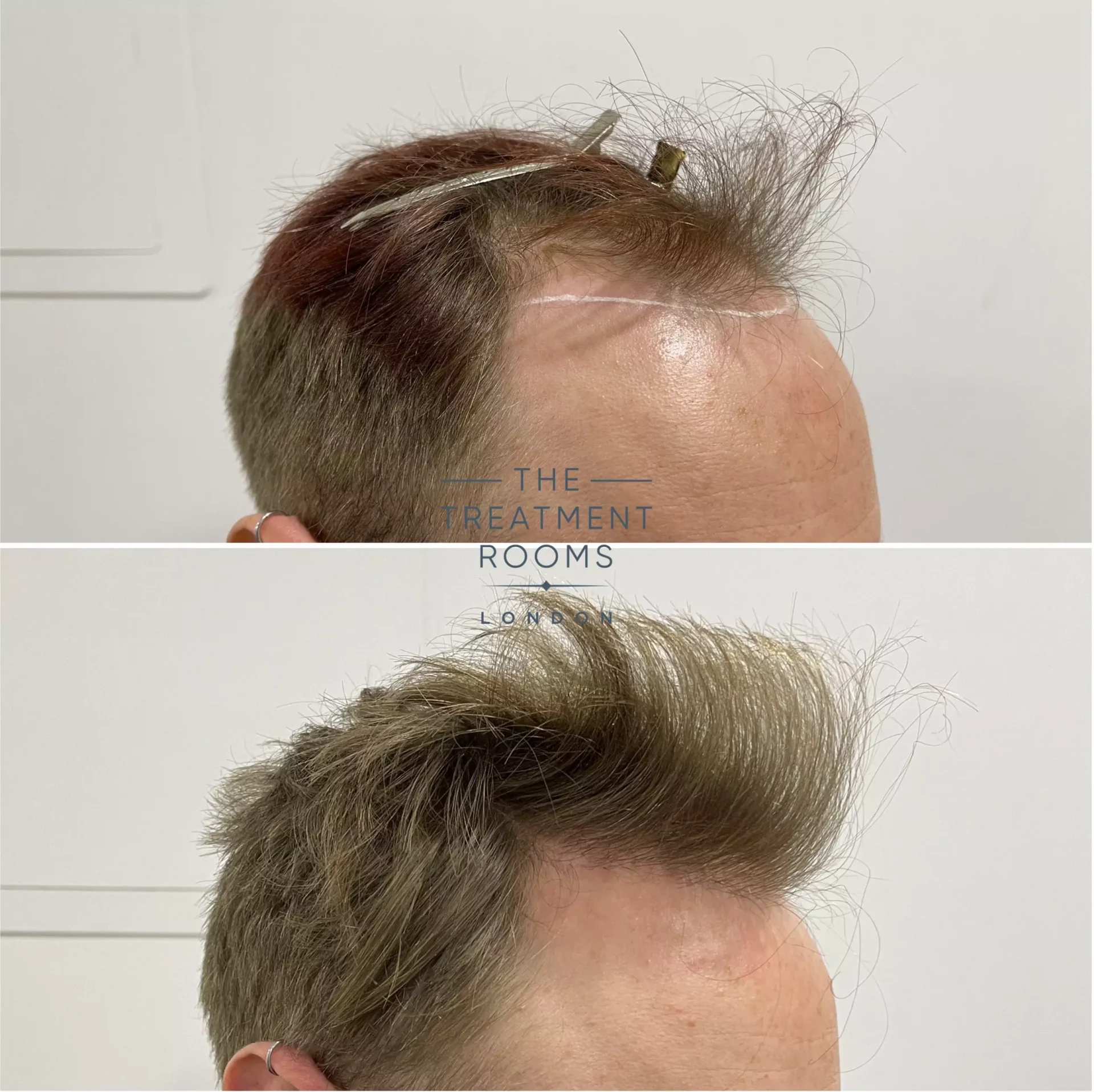 hairline hair transplant london 1693 grafts before and after