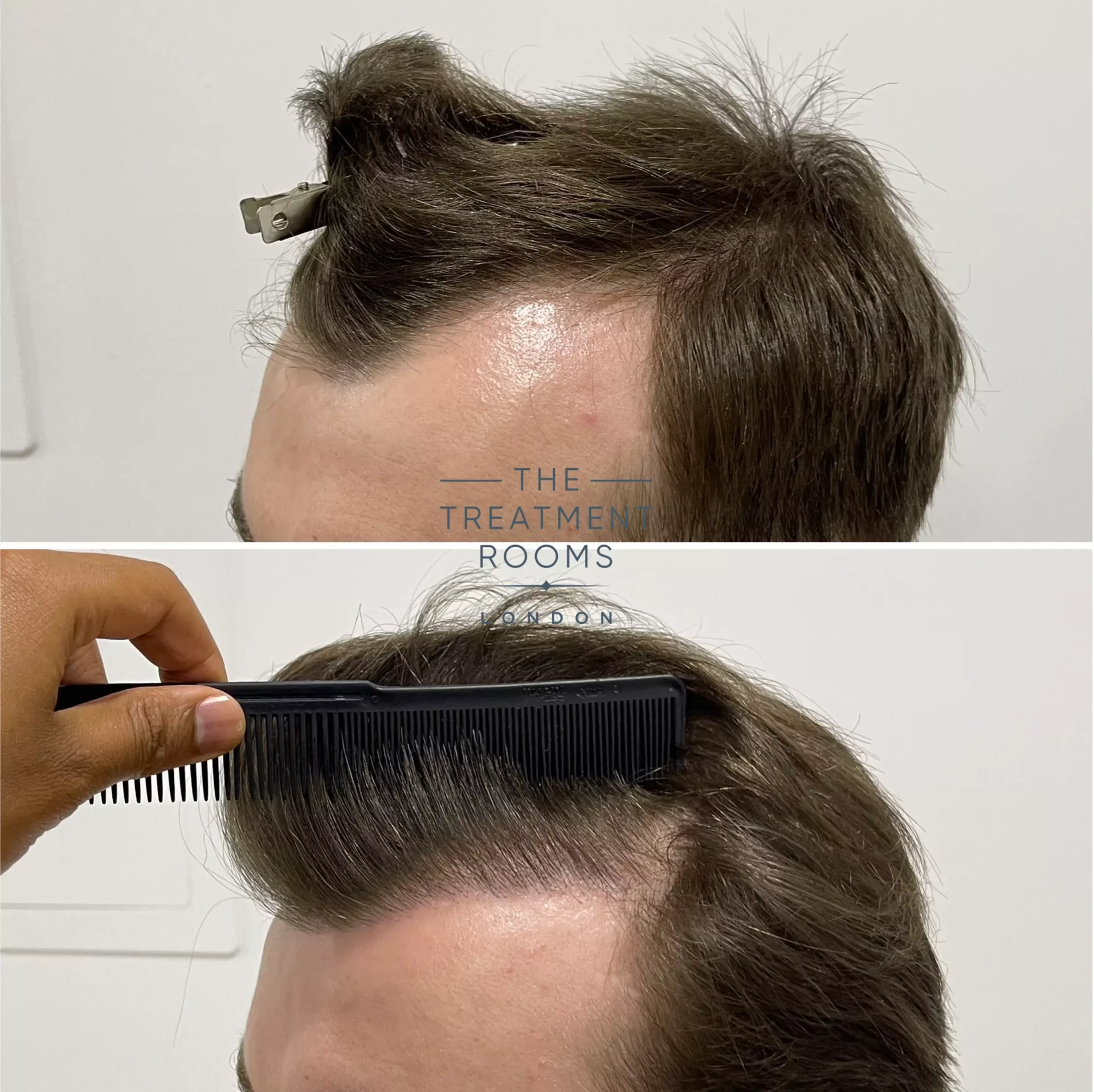 hairline hair transplant london before and after 1357 grafts