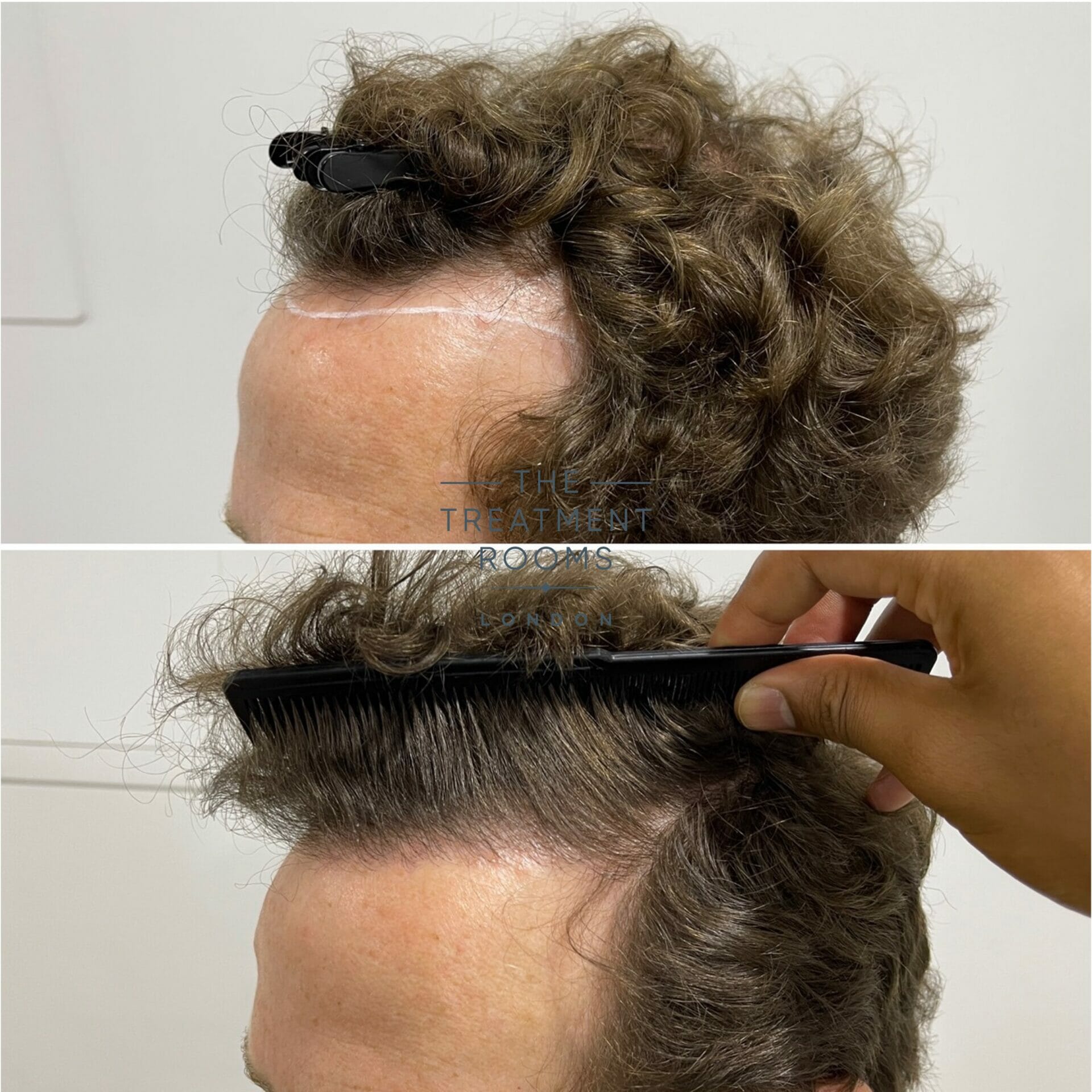 hairline hair transplant result 1304 grafts