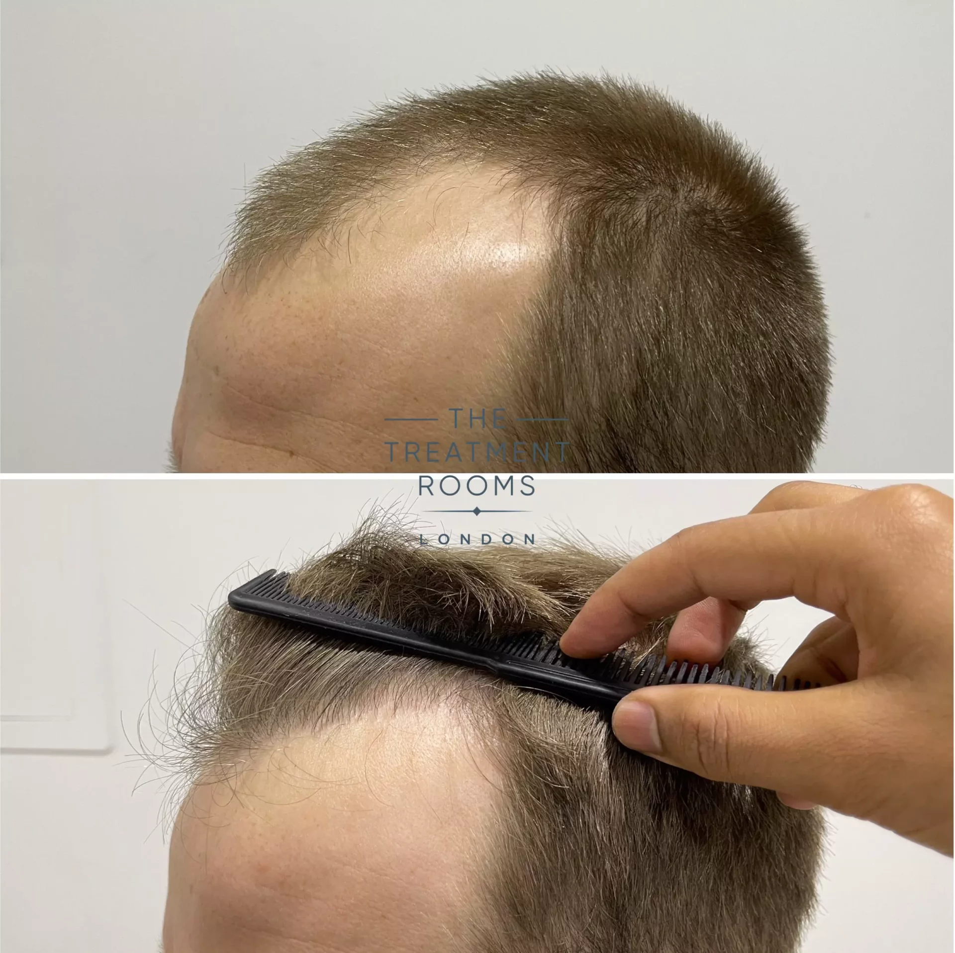 hairline hair transplant result 1756 grafts