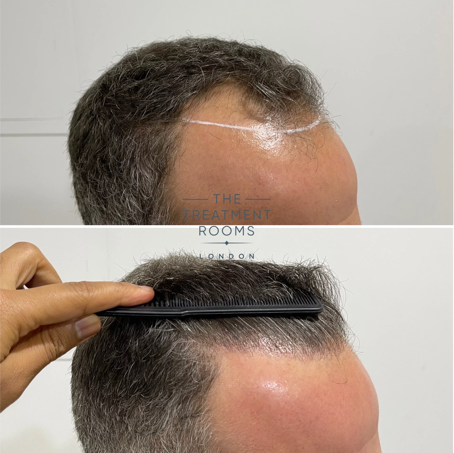 hairline hair transplant result 1788 grafts result