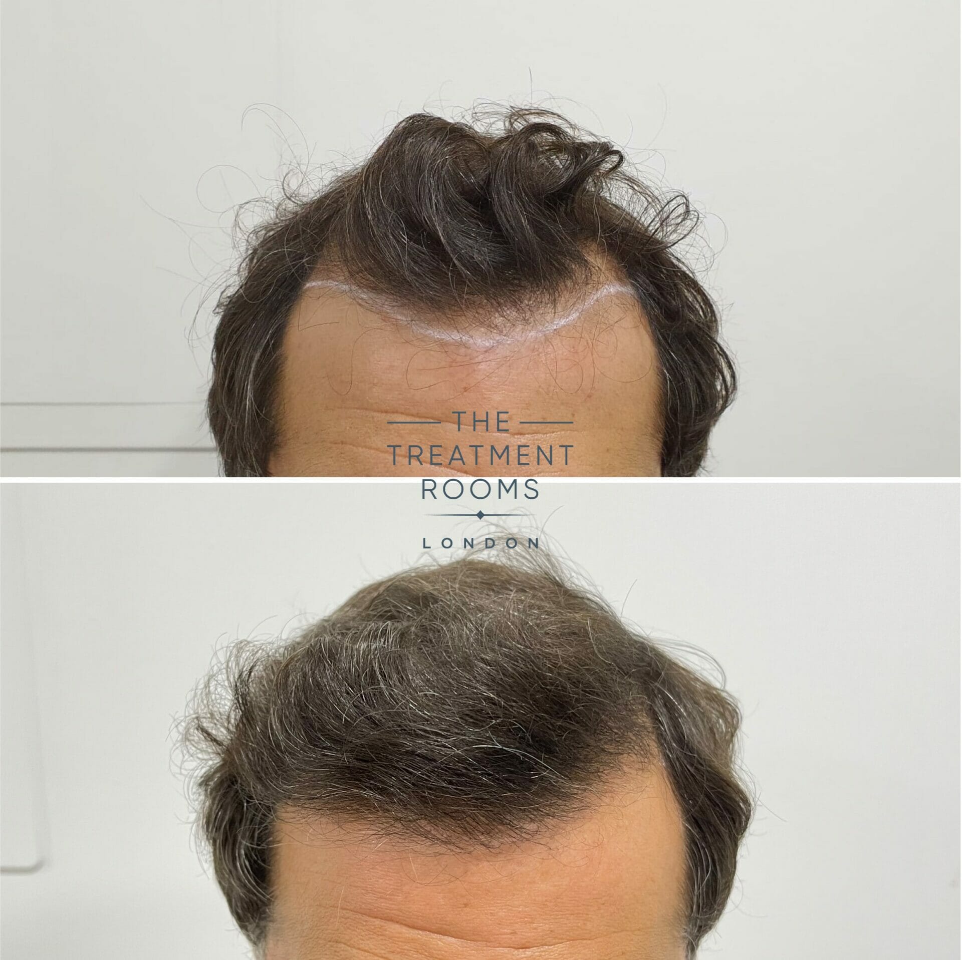 hairline hair transplant result