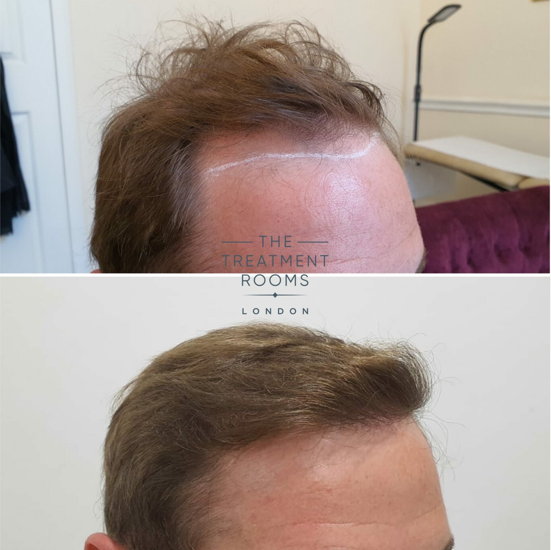 hairline hair transplant result 2018 grafts