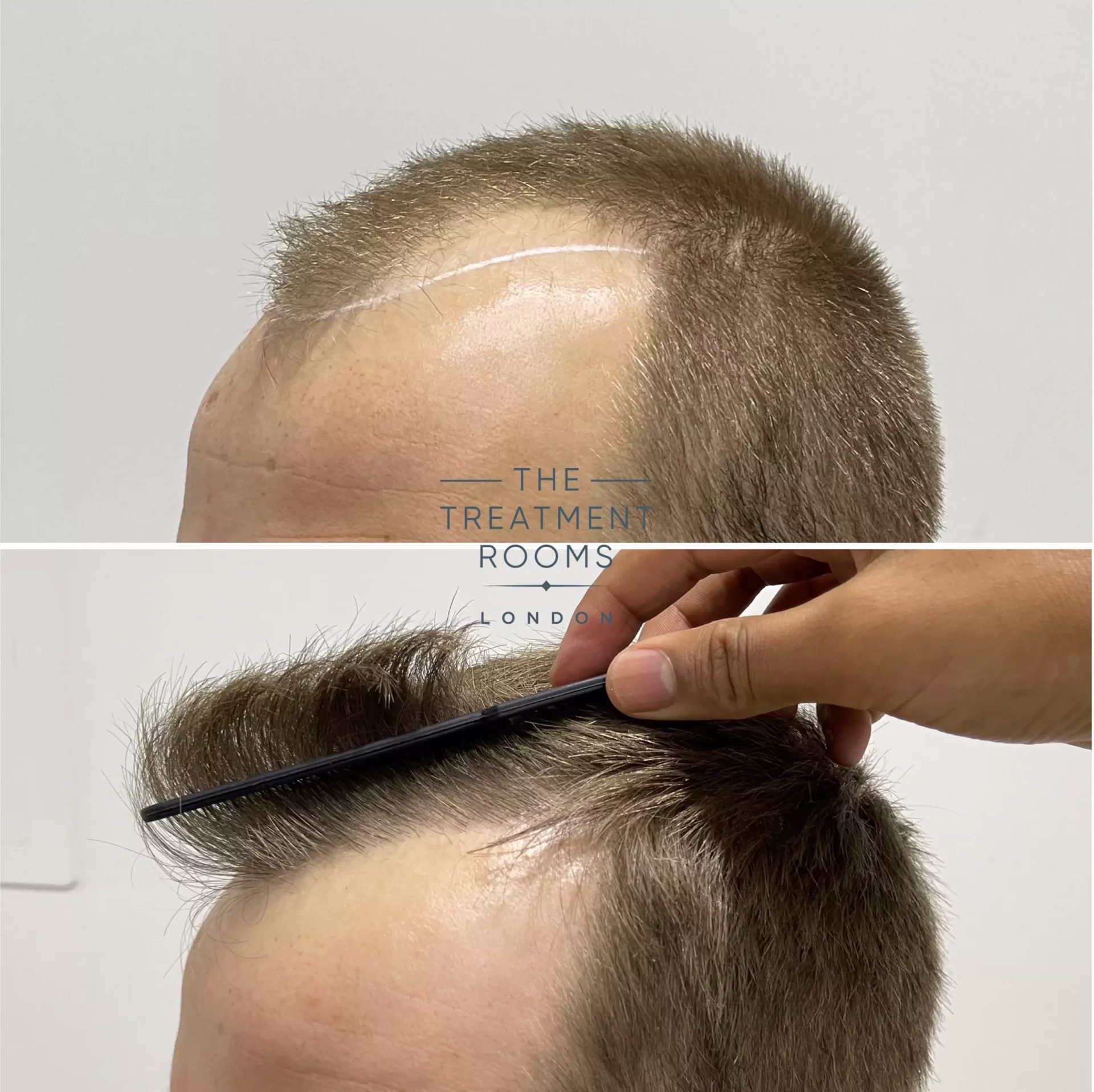 hairline transplant 1756 grafts before and after
