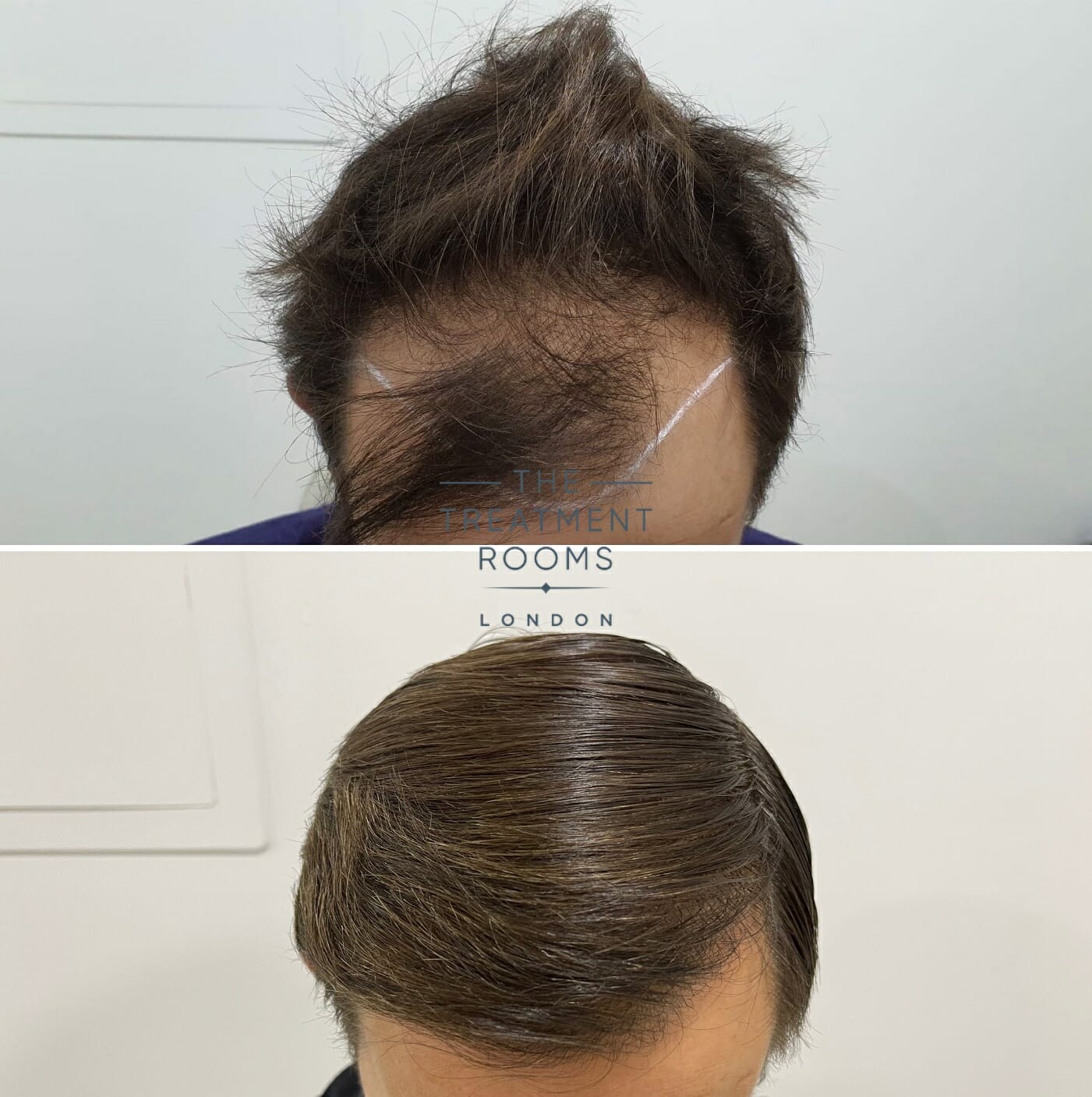 hairline transplant before and after