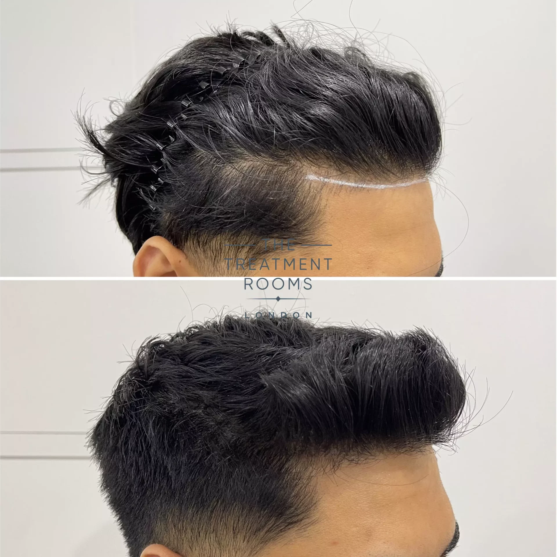 hairline transplant london 1019 grafts before and after