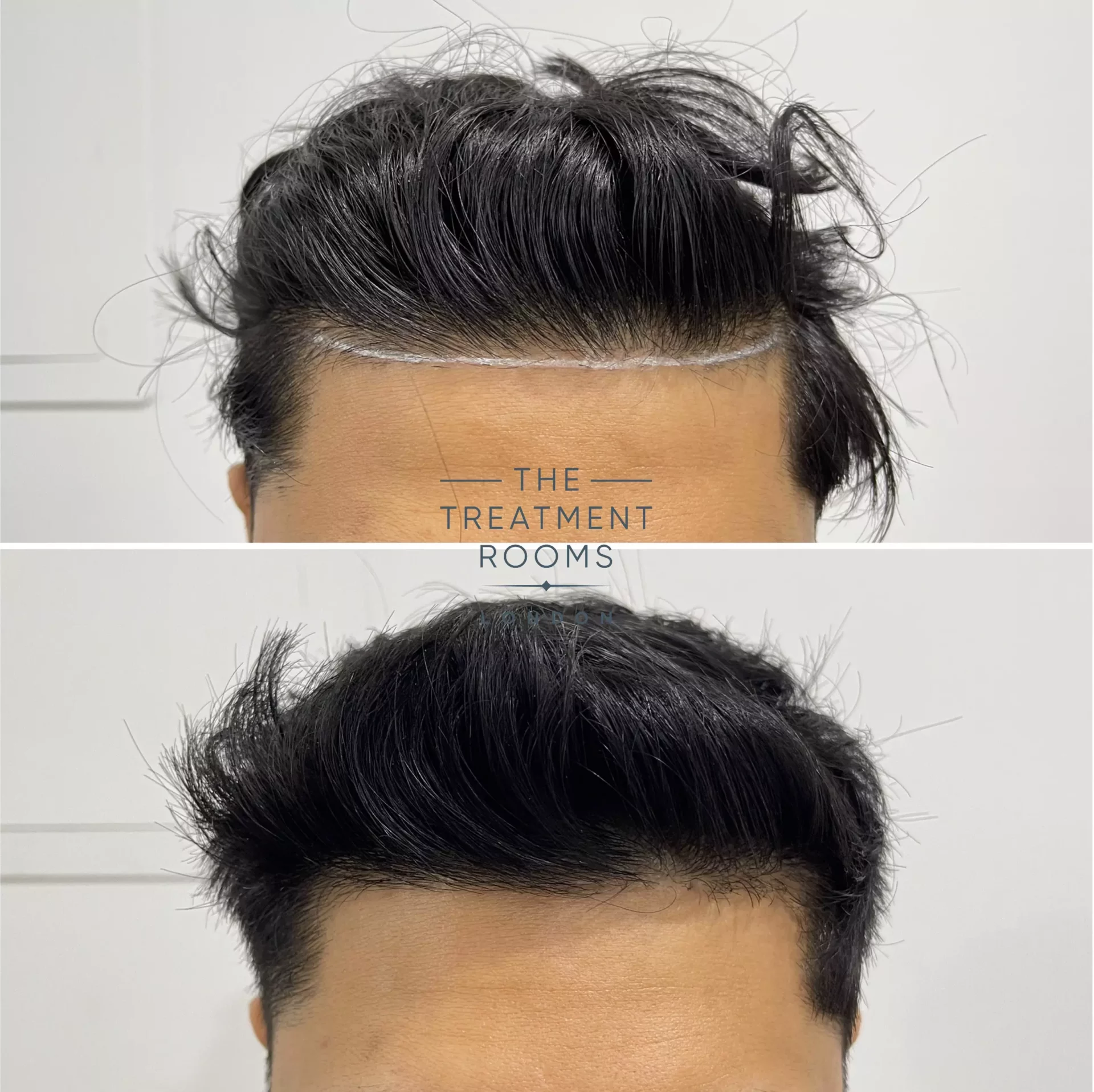 hairline transplant london 1019 grafts