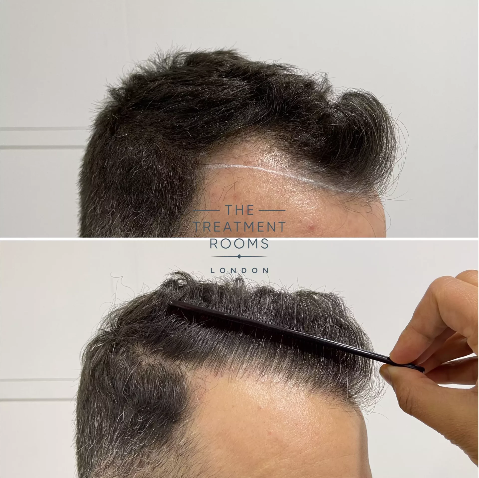 hairline transplant london 1321 grafts before and after