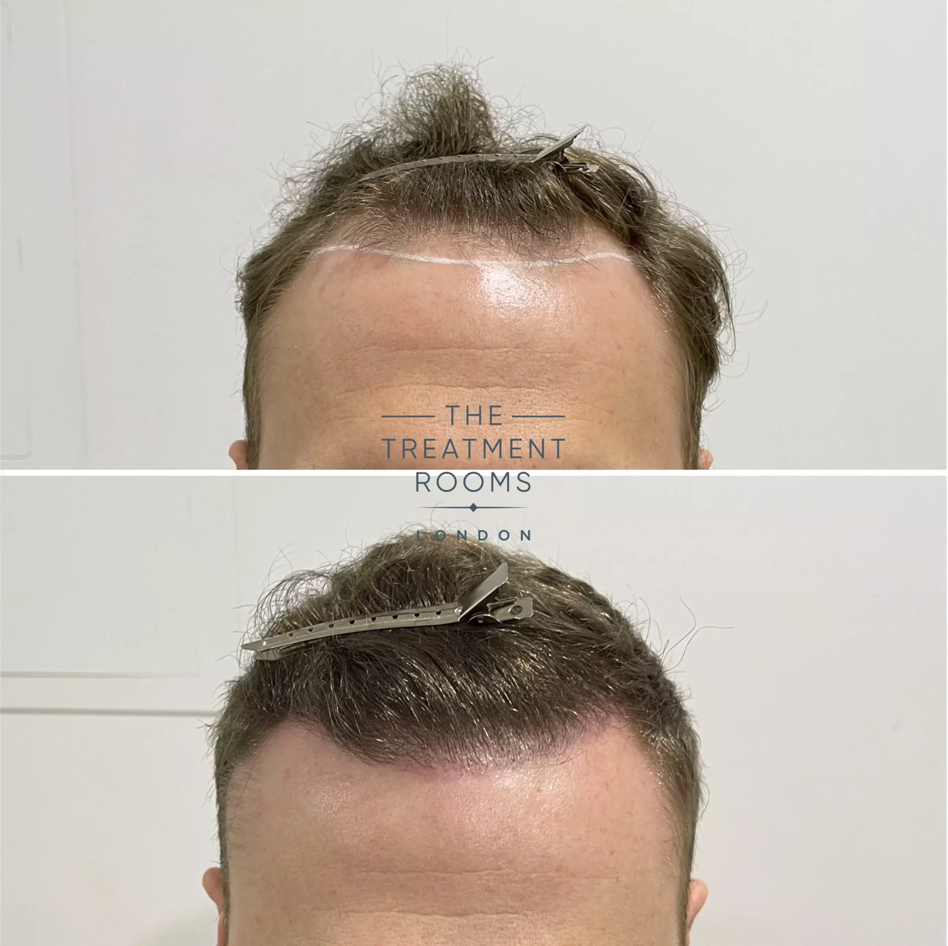 hairline transplant london 1346 grafts before and after