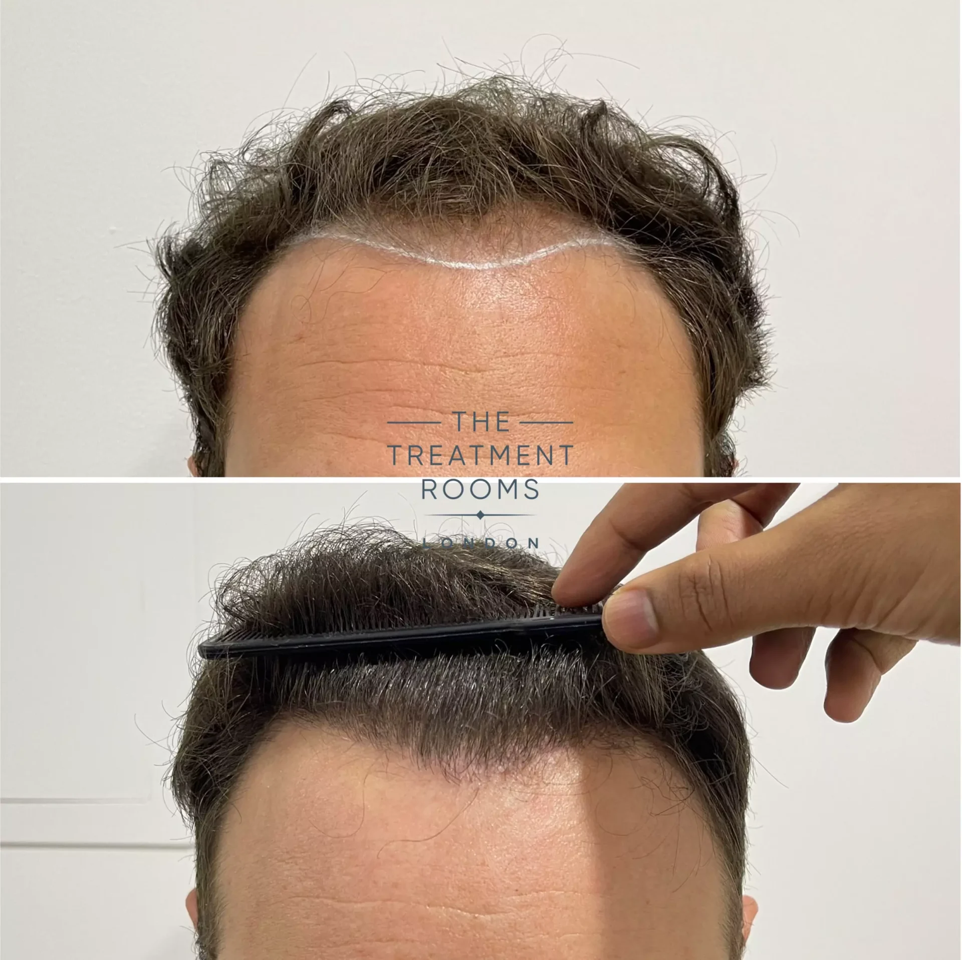 hairline transplant london 1736 grafts before and after