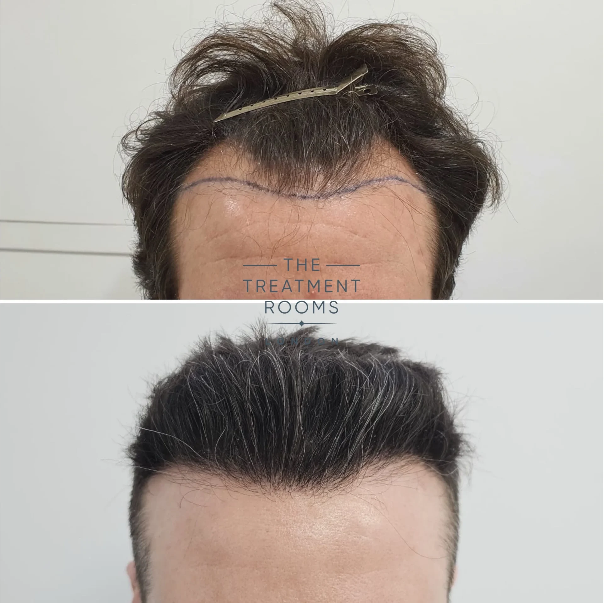 hairline transplant london 1745 grafts before and after