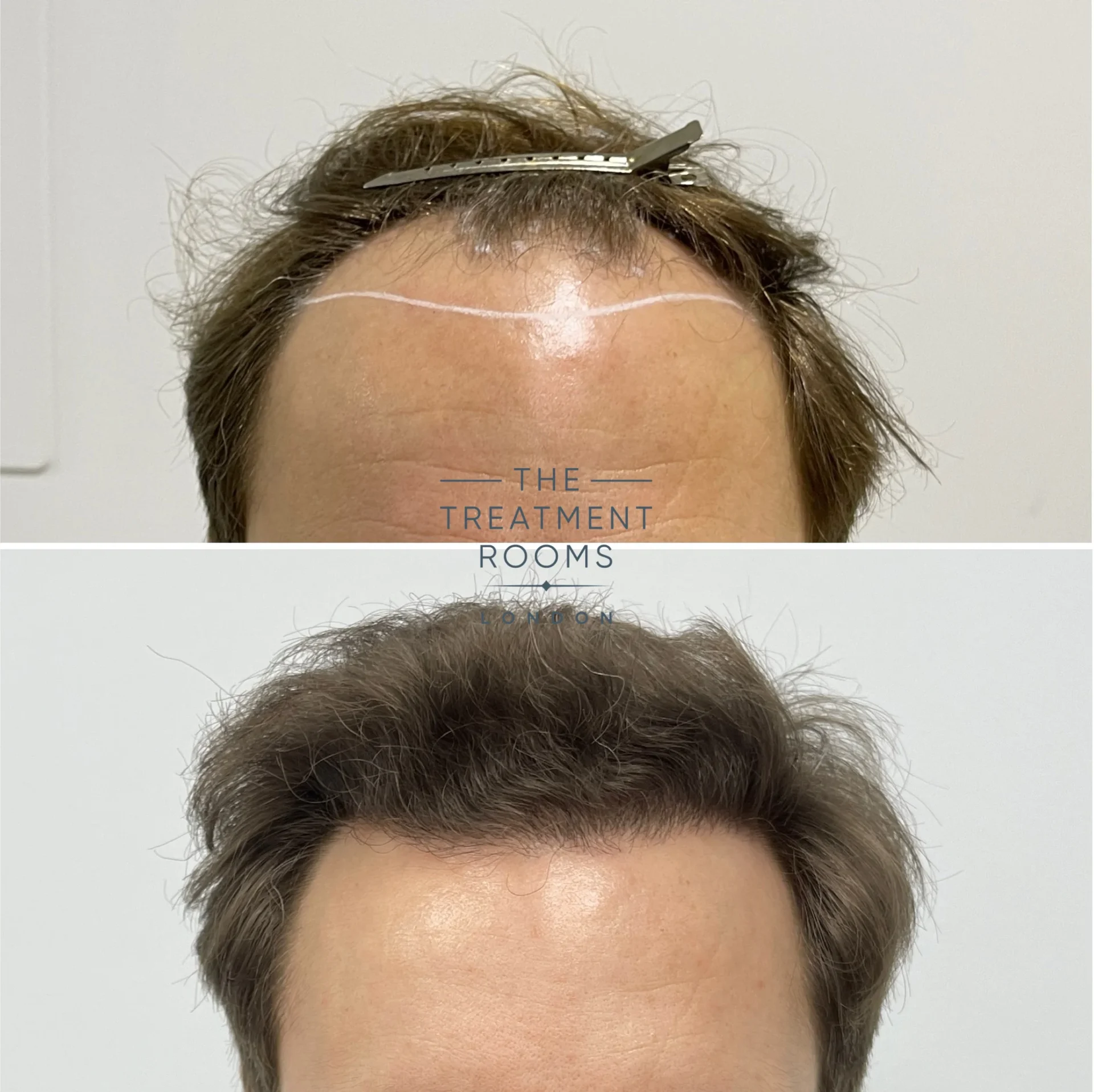 hairline transplant london 2037 grafts result