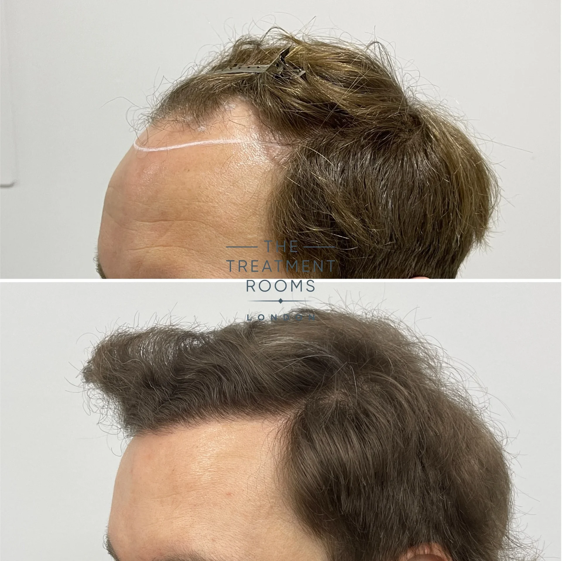 hairline transplant london 2037 grafts