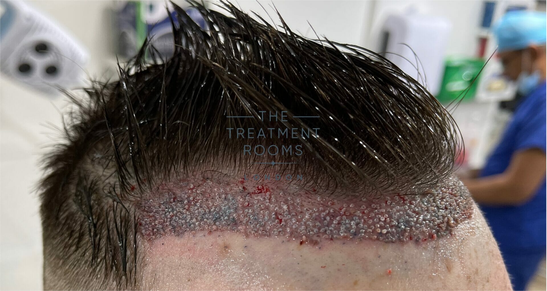 high density hair transplant