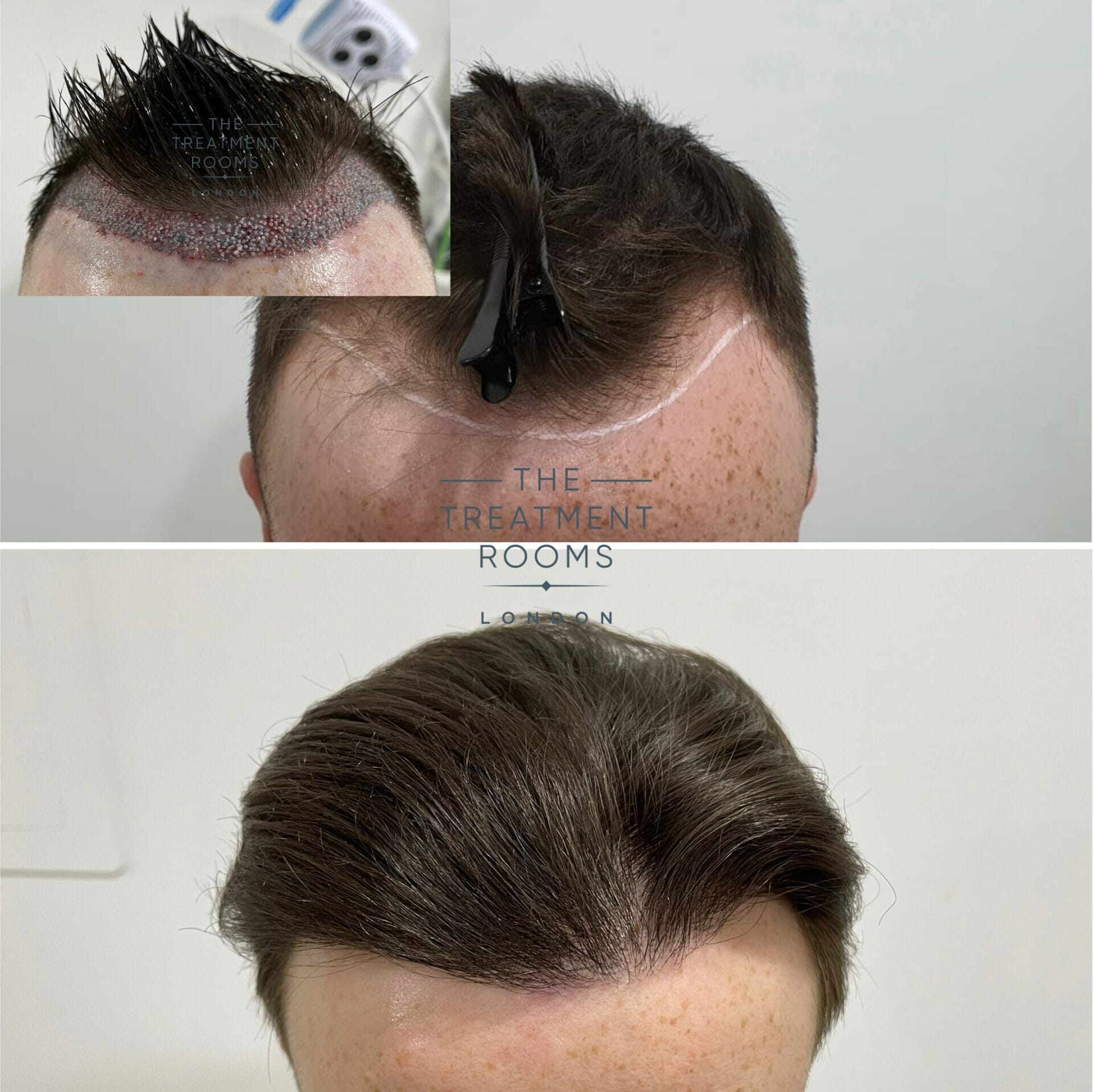 high density hair transplant before and after