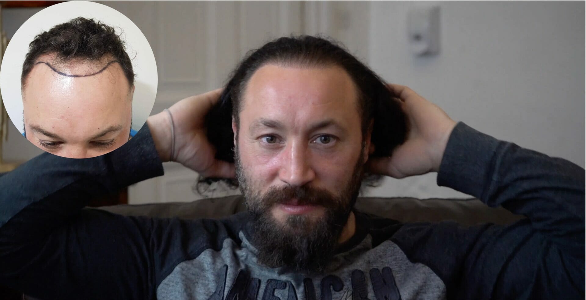 A Guide to High Density Hair Transplantation - Hair Transplant Specialists - Treatment Rooms London A Guide to High Density Hair Transplantation - Hair Transplant Specialists - Treatment Rooms London