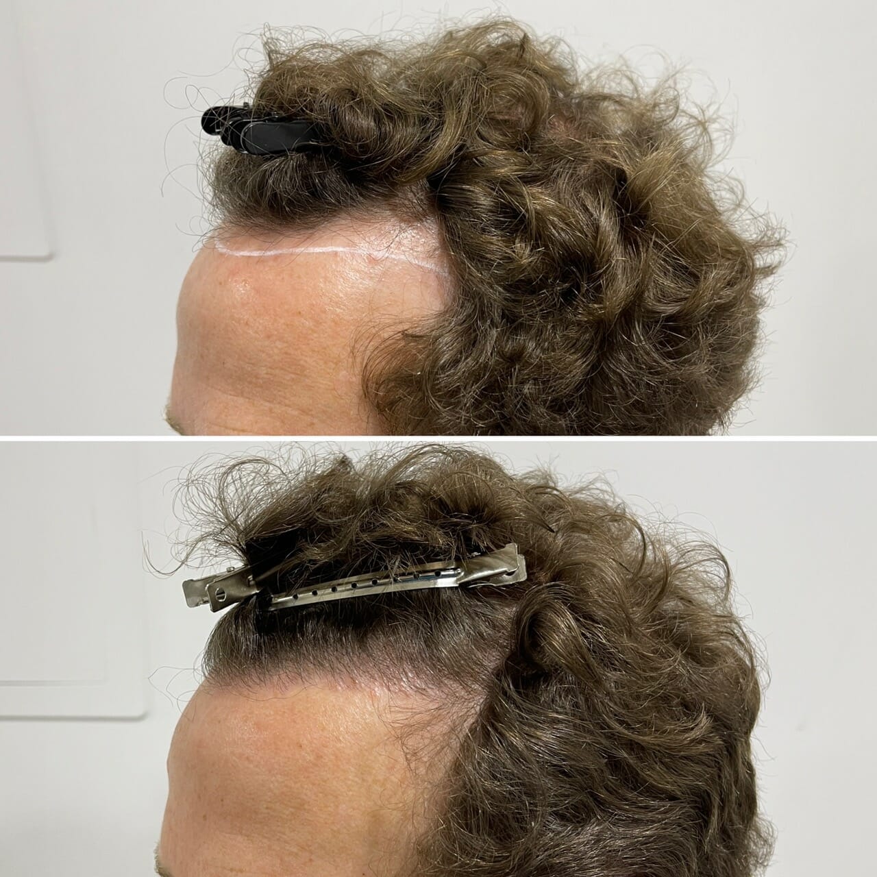 hot weather hair transplant