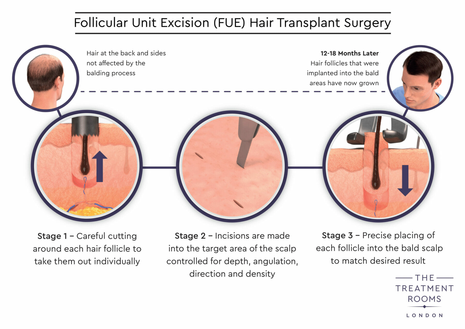 how many grafts for FUE hair transplant