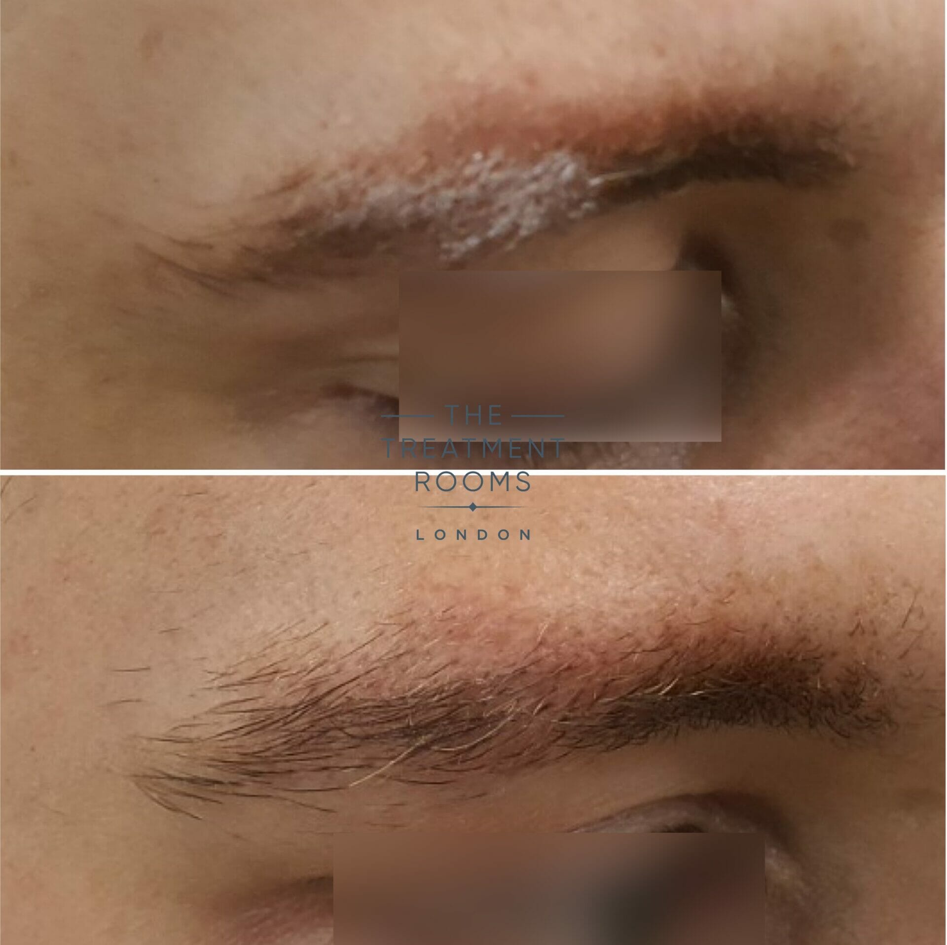 how much does an eyebrow hair transplant cost