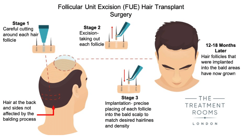 Hair Transplant Surgery Diagram Hair Transplant Surgery Diagram
