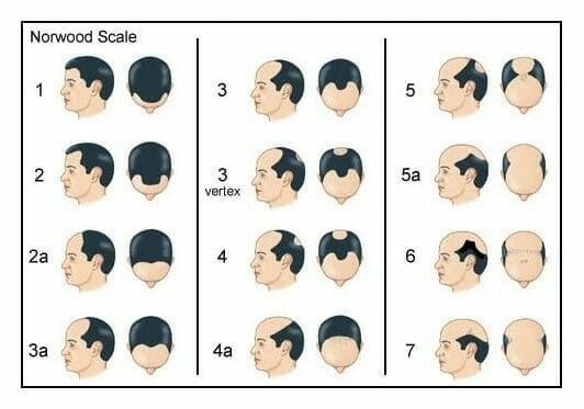 Norwood scale hair loss male