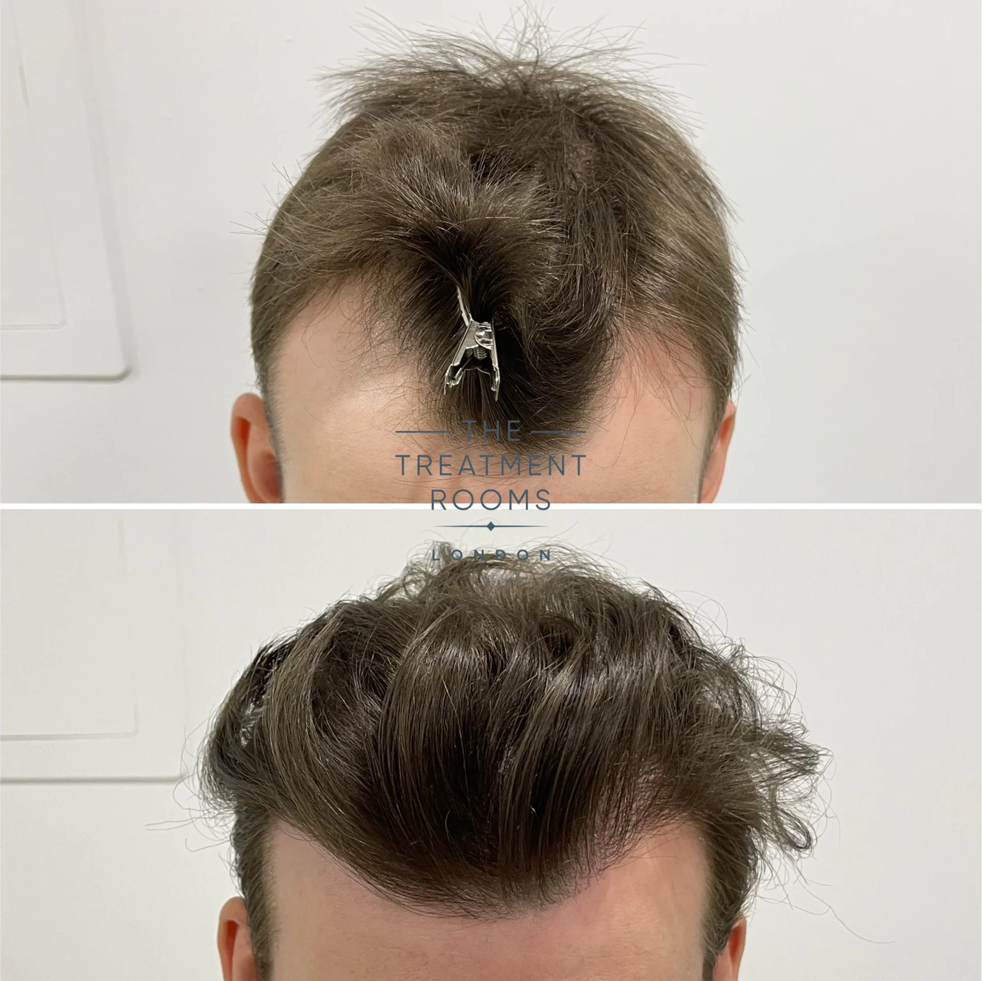 is a hair transplant painful