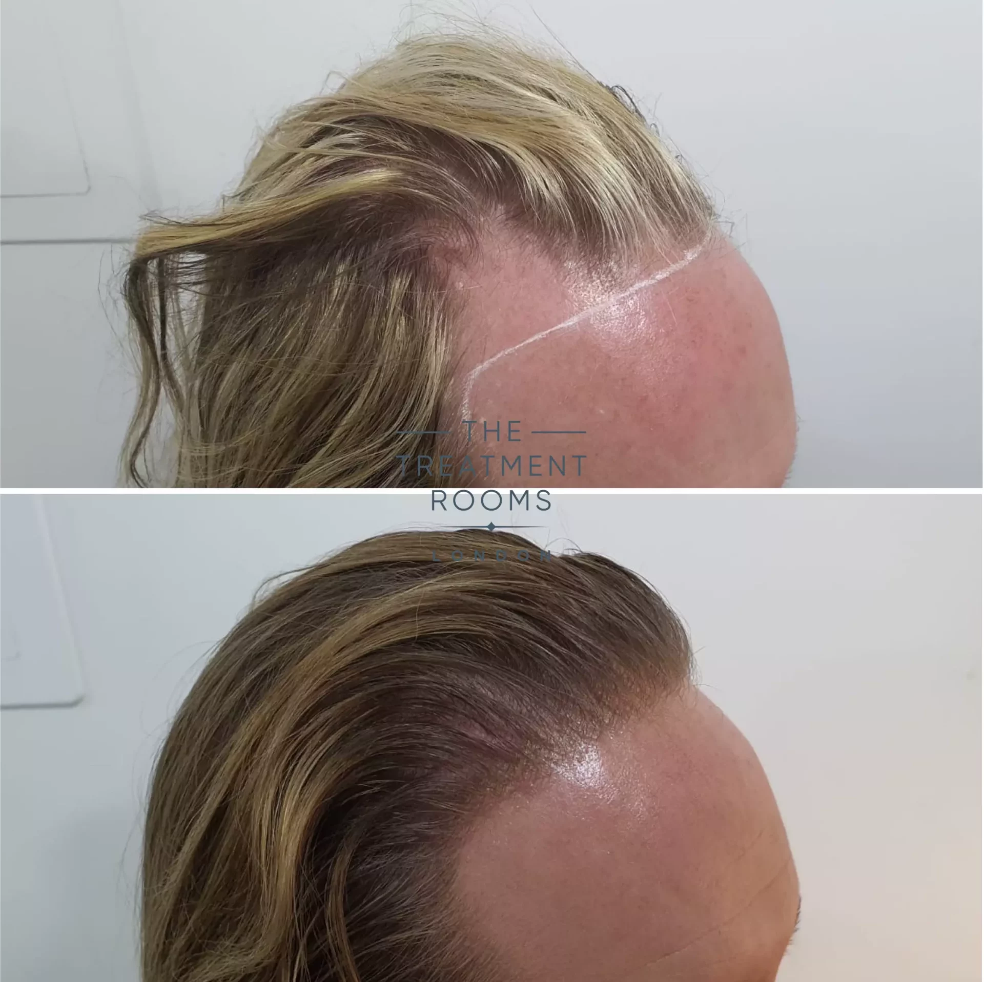 large transgender hair transplant cost hairline feminisation