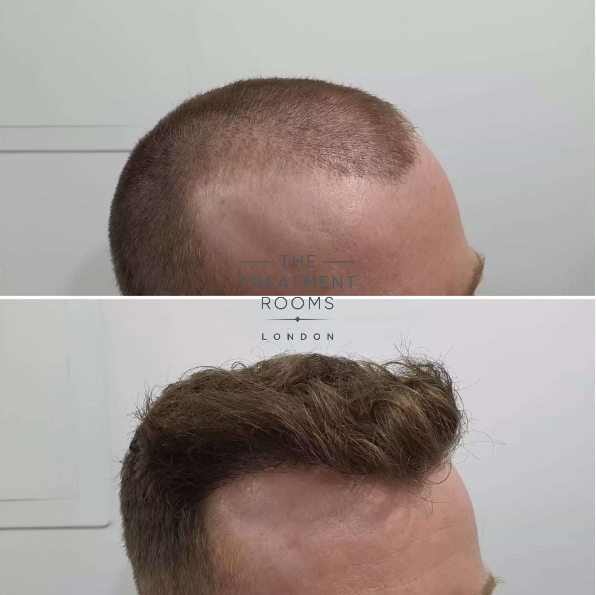 london fue hair transplant 1539 grafts before and after