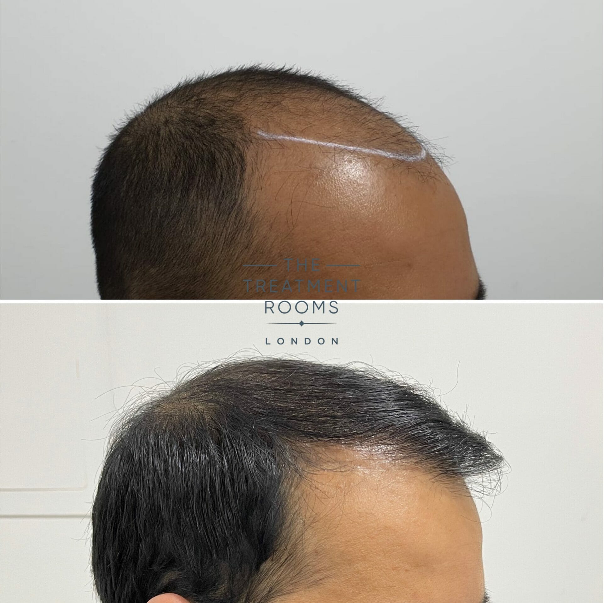 london fue hair transplant before and after 1911