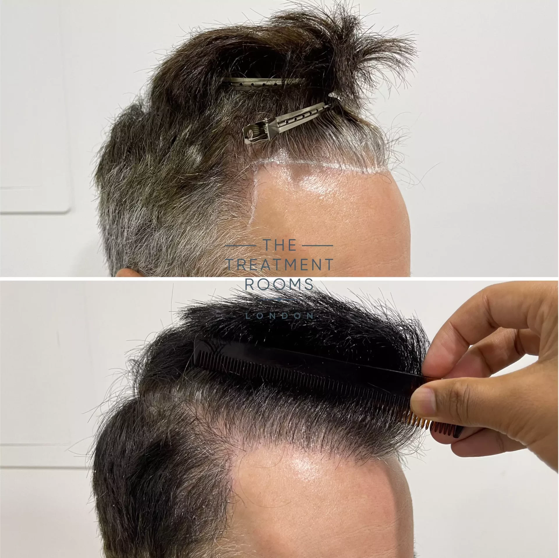 london hair transplant clinic repair 1264 grafts