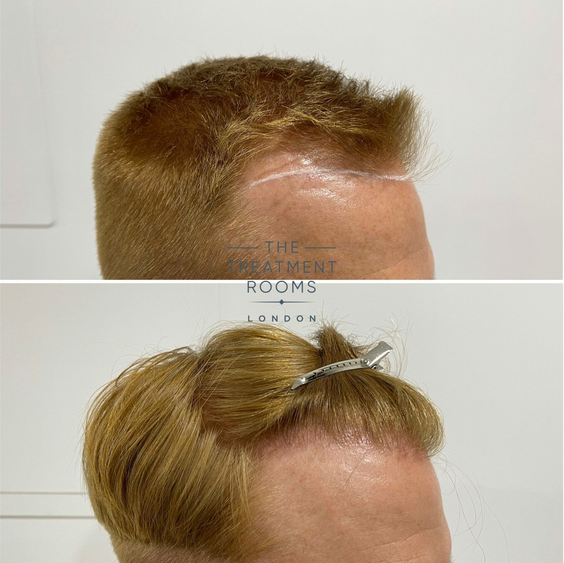 london hair transplant 1426 grafts before and after