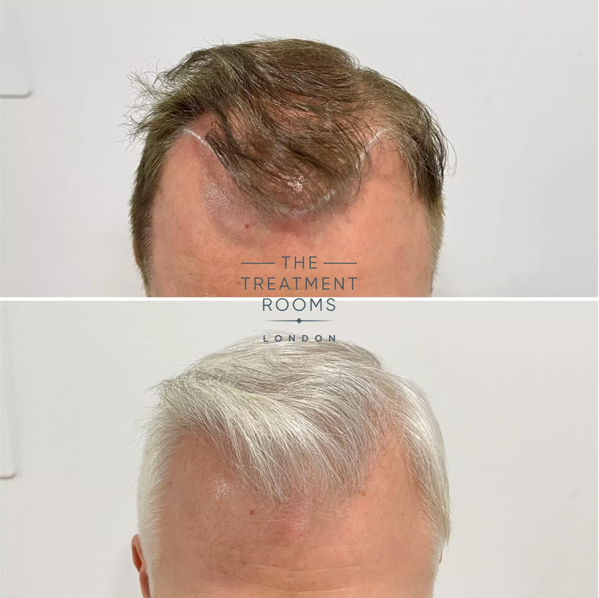 london hair transplant 1495 grafts before and after