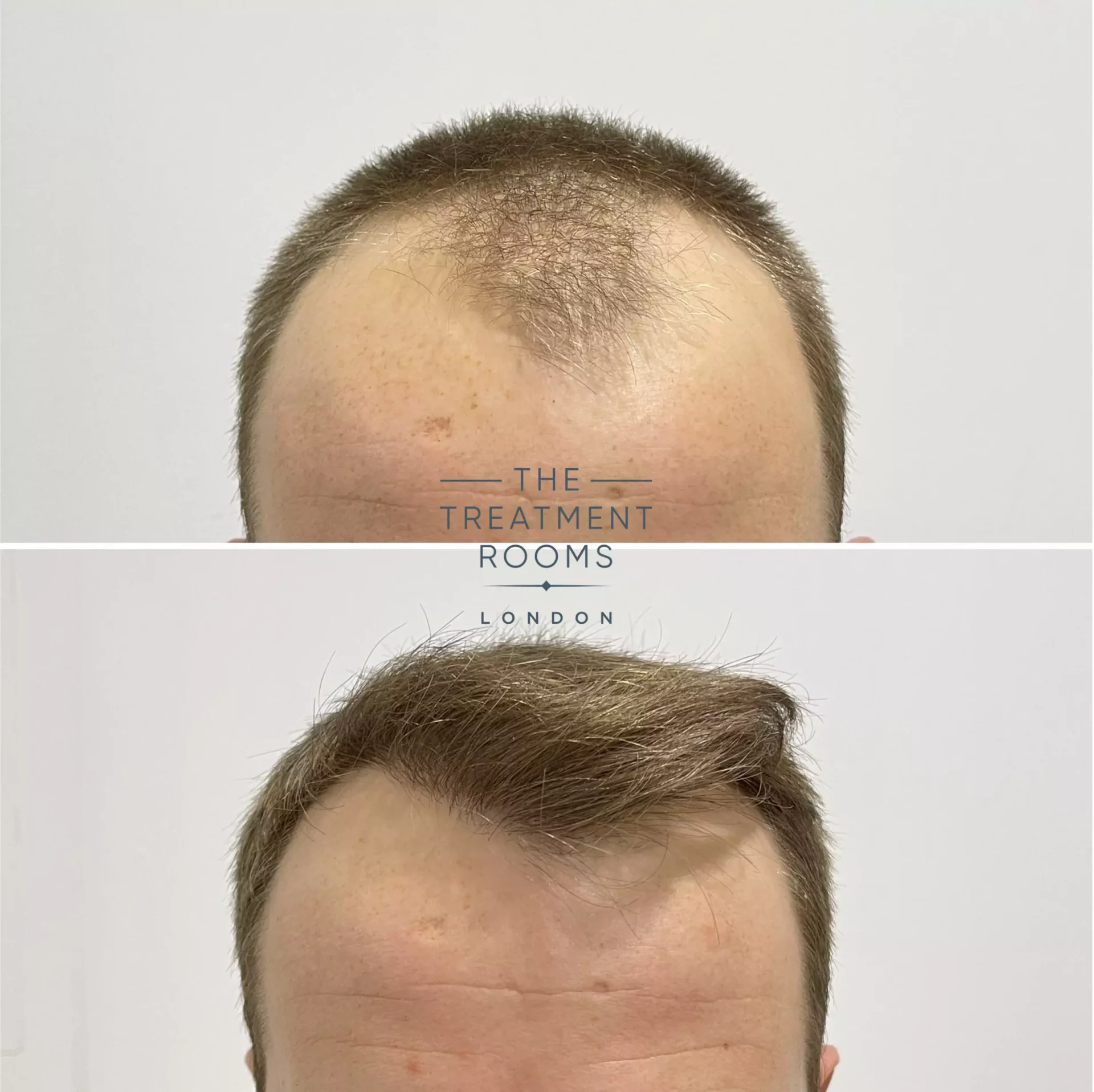 london hair transplant 1756 grafts before and after