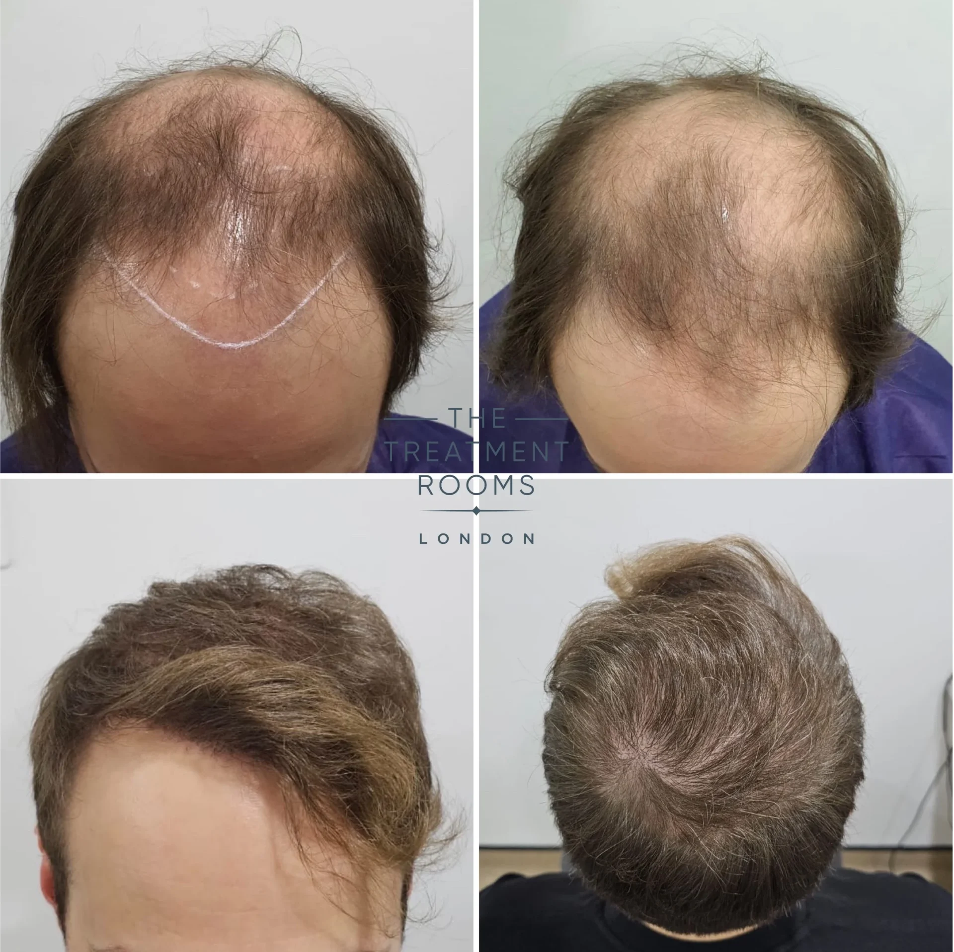 london hair transplant 4111 grafts result