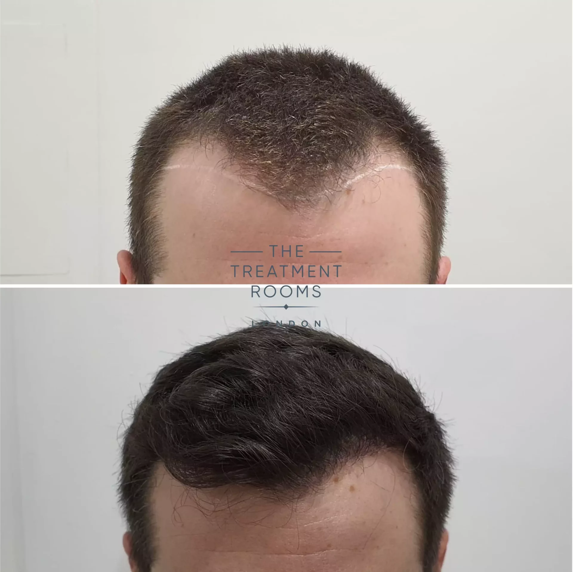 london hair transplant before and after 1297 grafts