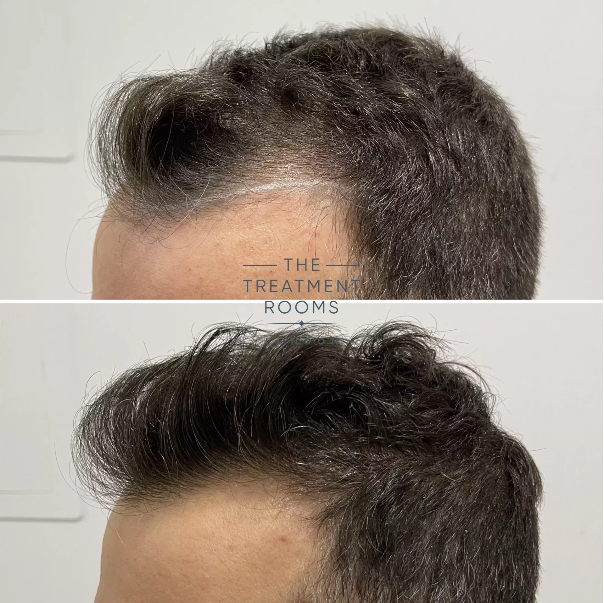 london hair transplant clinic 1321 grafts before and after