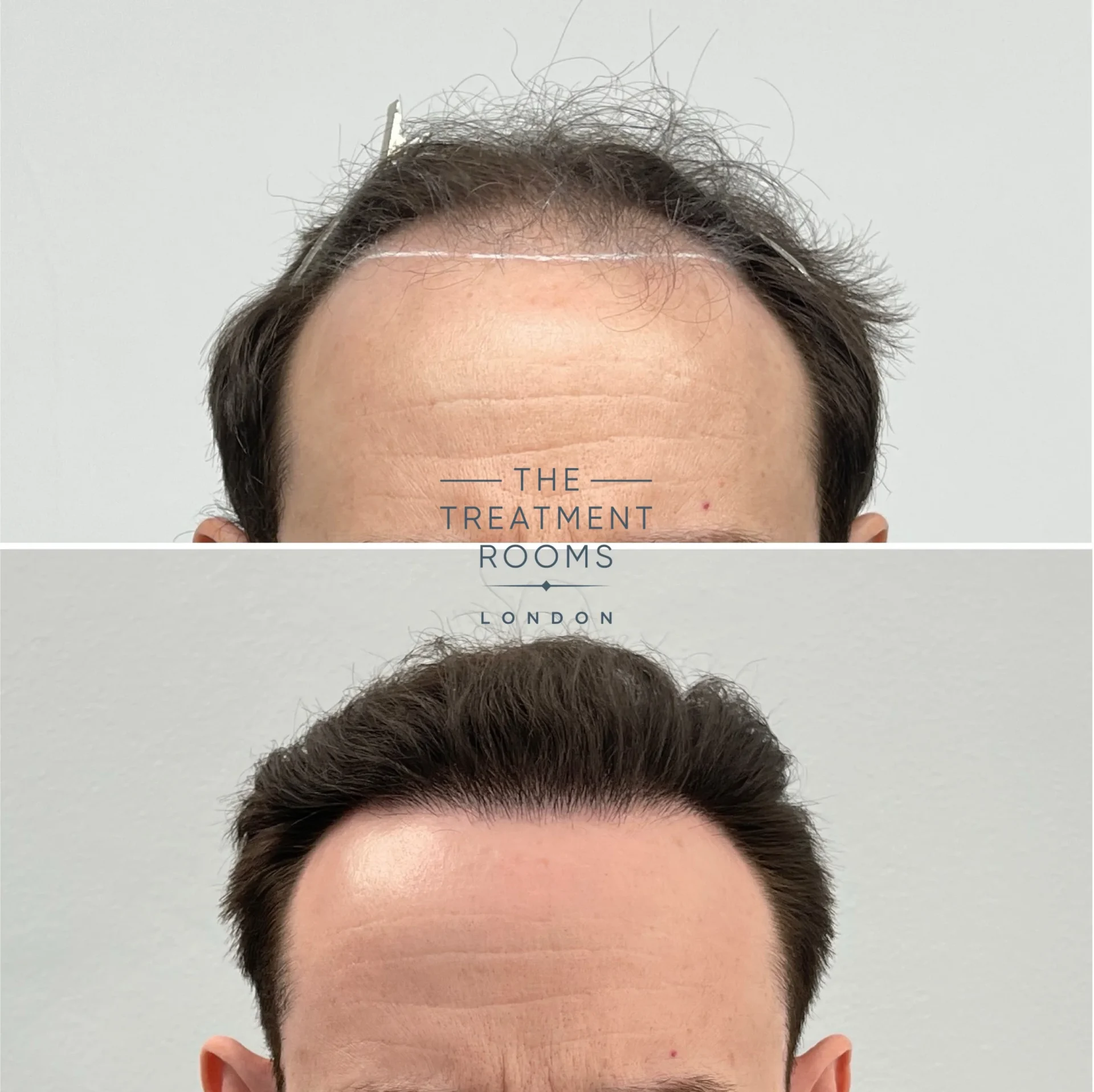 london hair transplant clinic 1960 grafts before and after