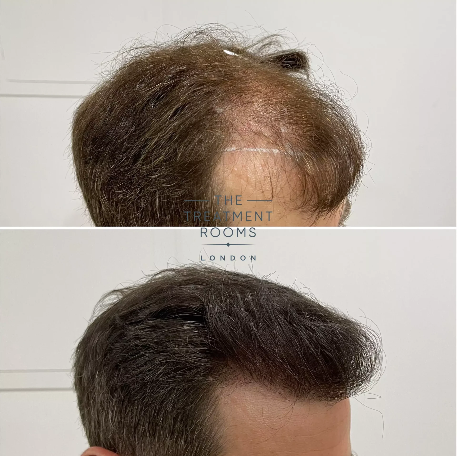 london hair transplant clinic before and after 1491 grafts