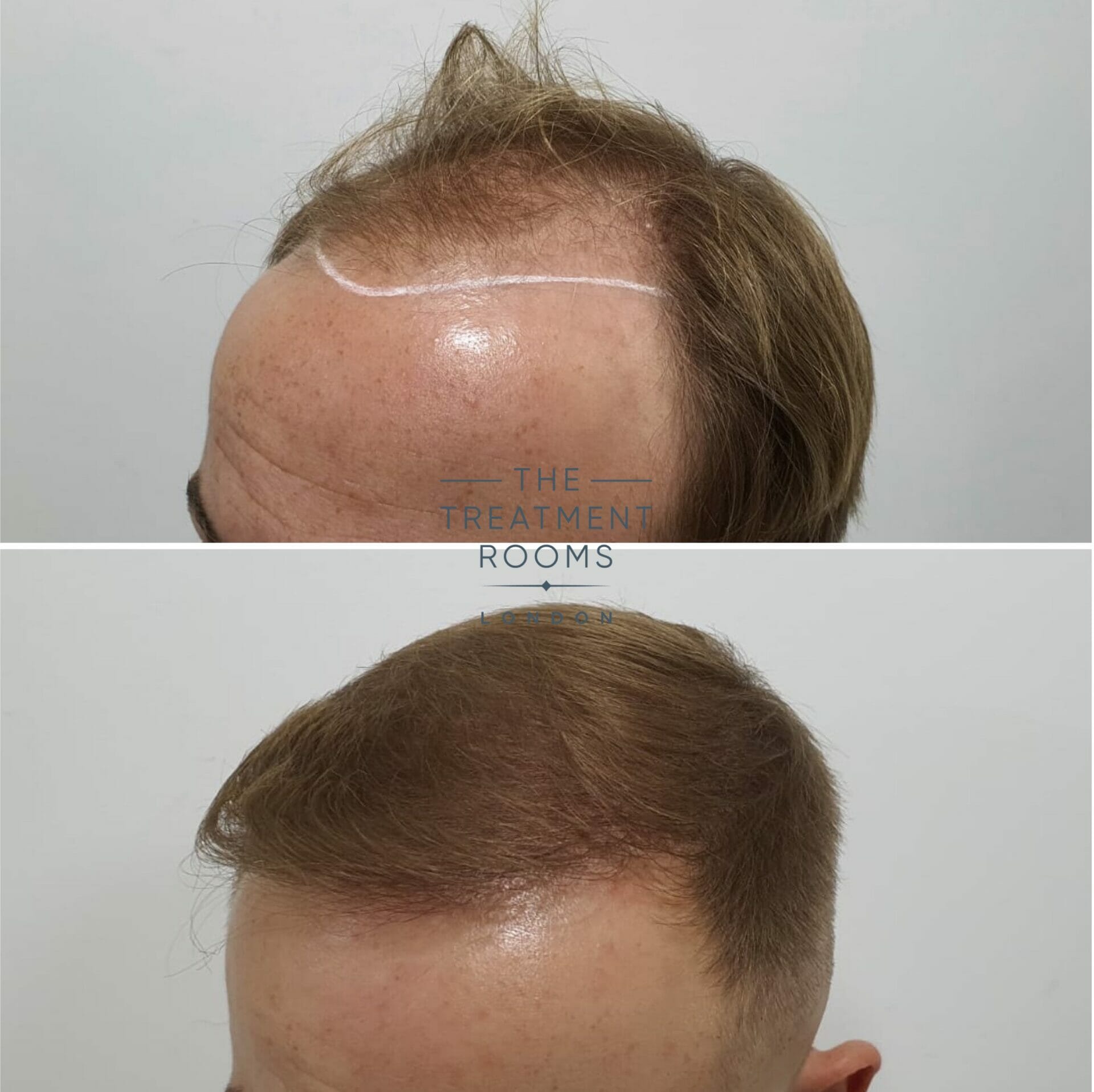 male fue hair transplant before and after 2190 grafts
