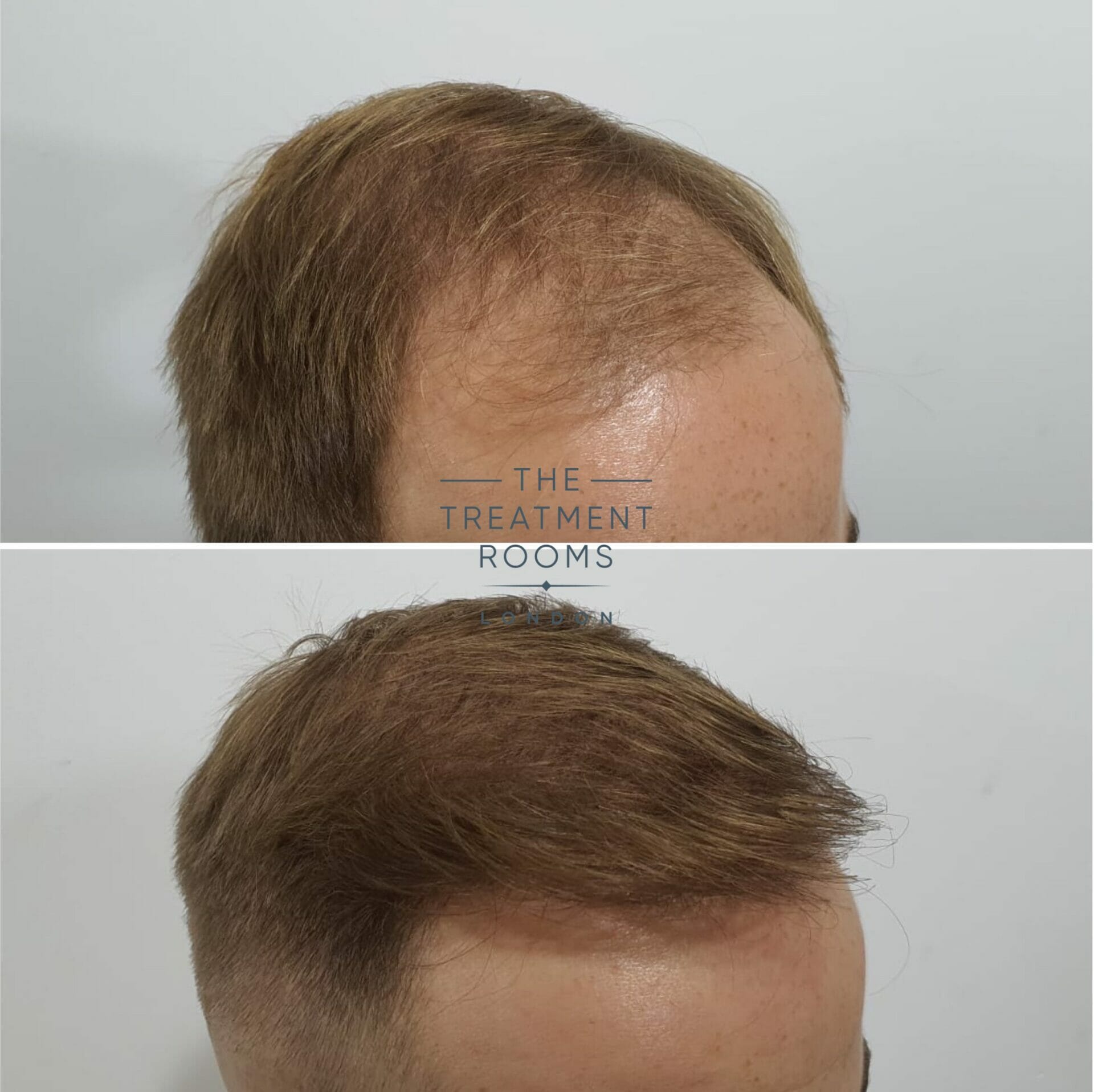 male hair transplant UK before and after 2190 grafts