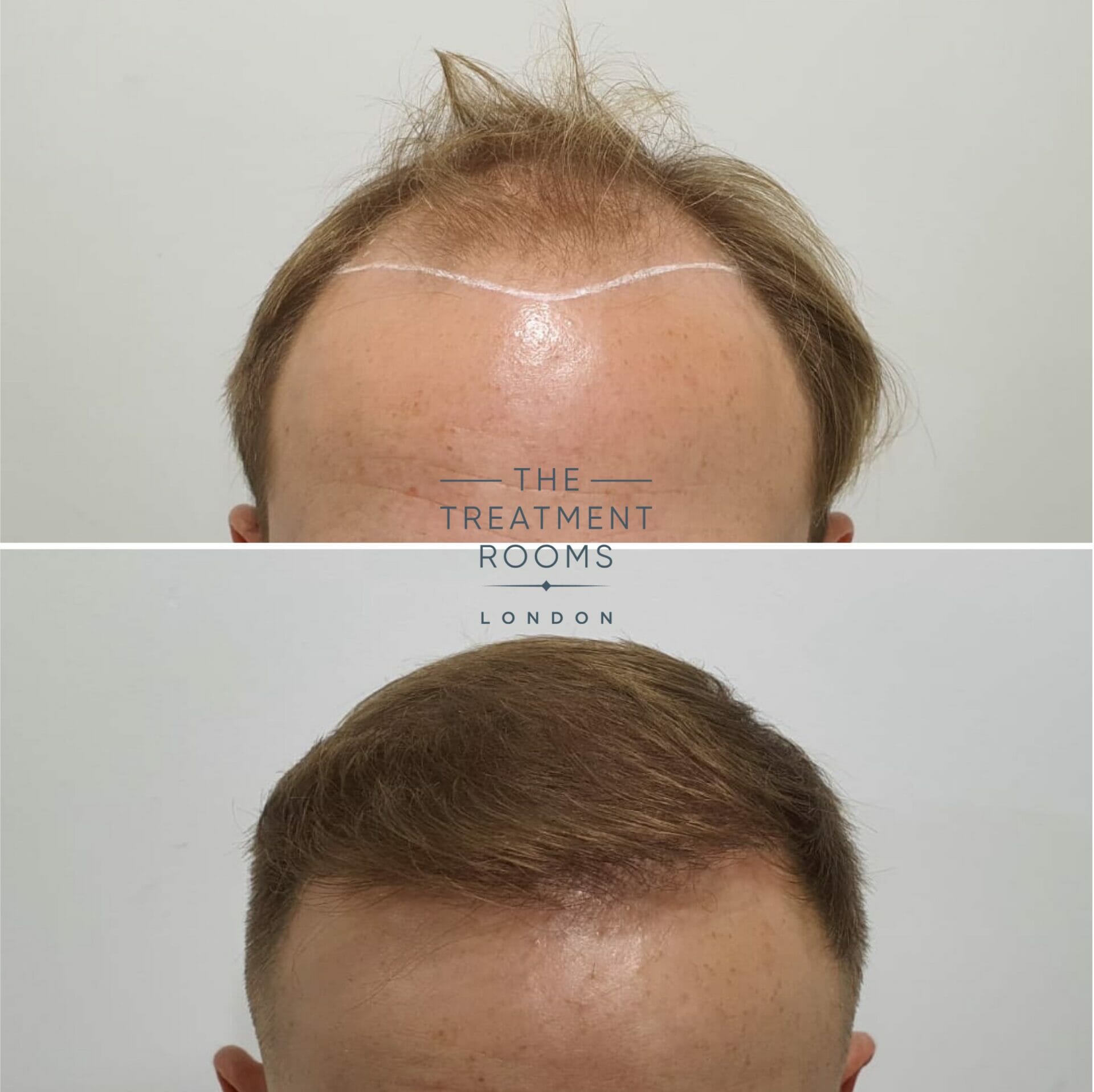 male hair transplant before and after 2190 grafts