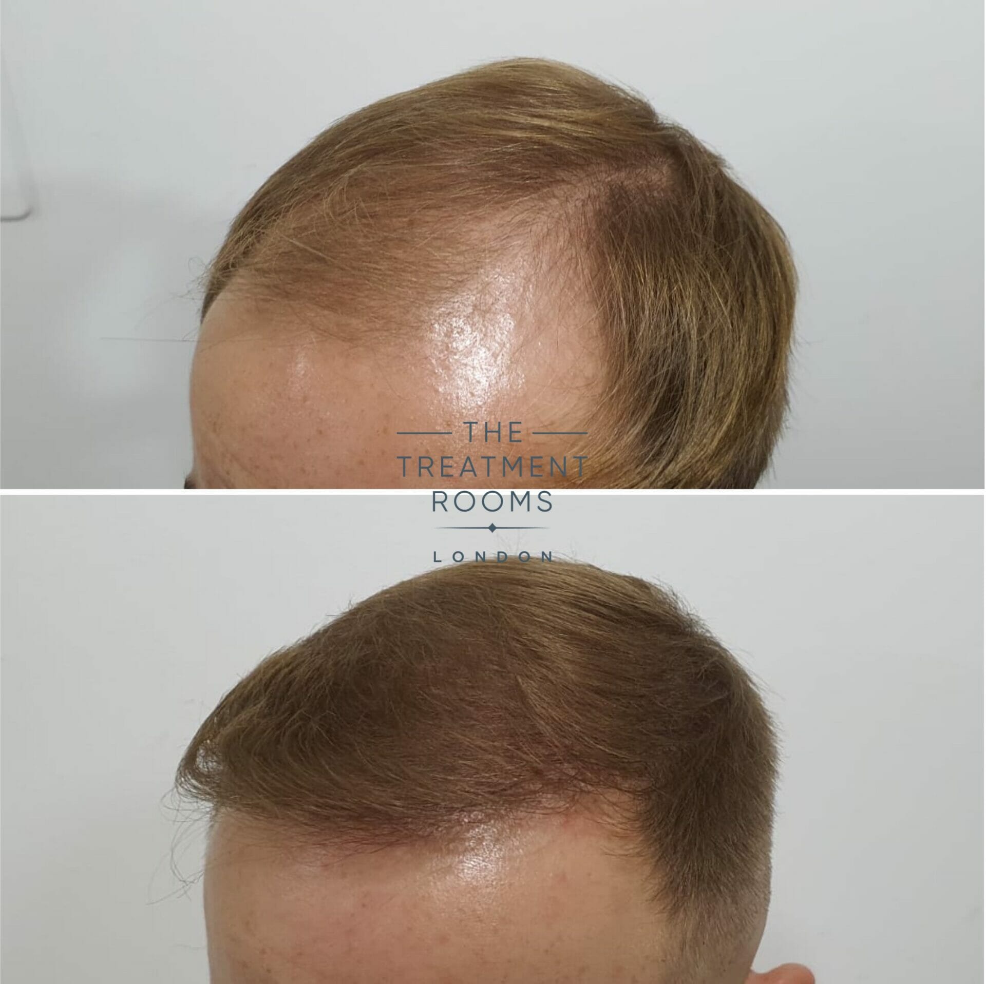 male hair transplant london before and after 2190 grafts