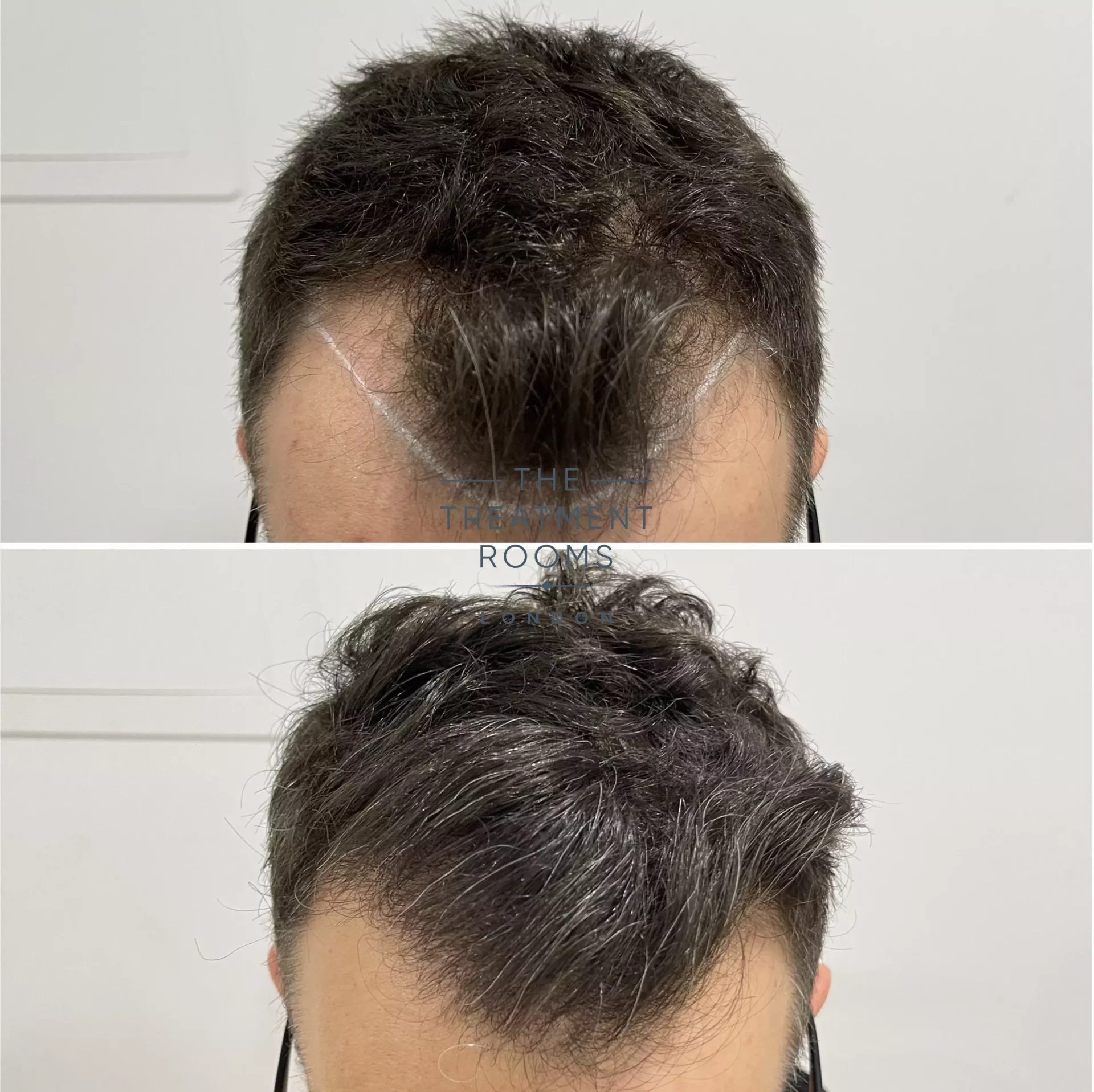 Temple Hair Loss & Temple Hair Transplant | Treatment Rooms London