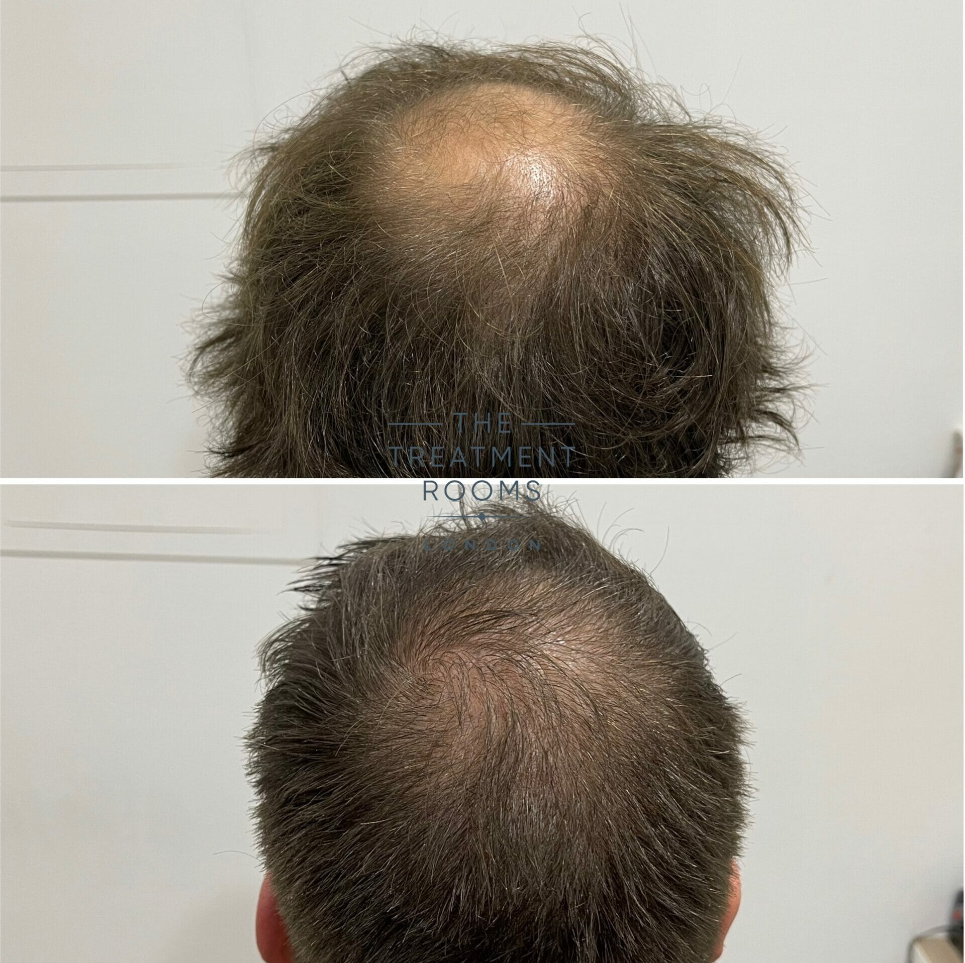 medium crown hair transplant cost