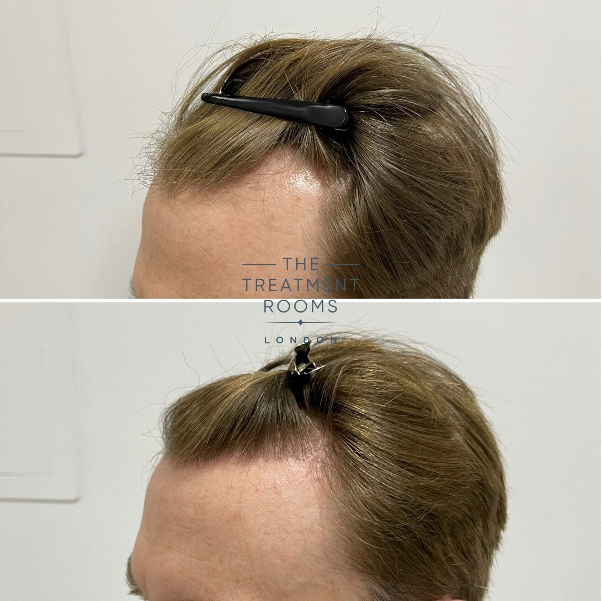 norwood 3 fue hair transplant before and after 1700 grafts