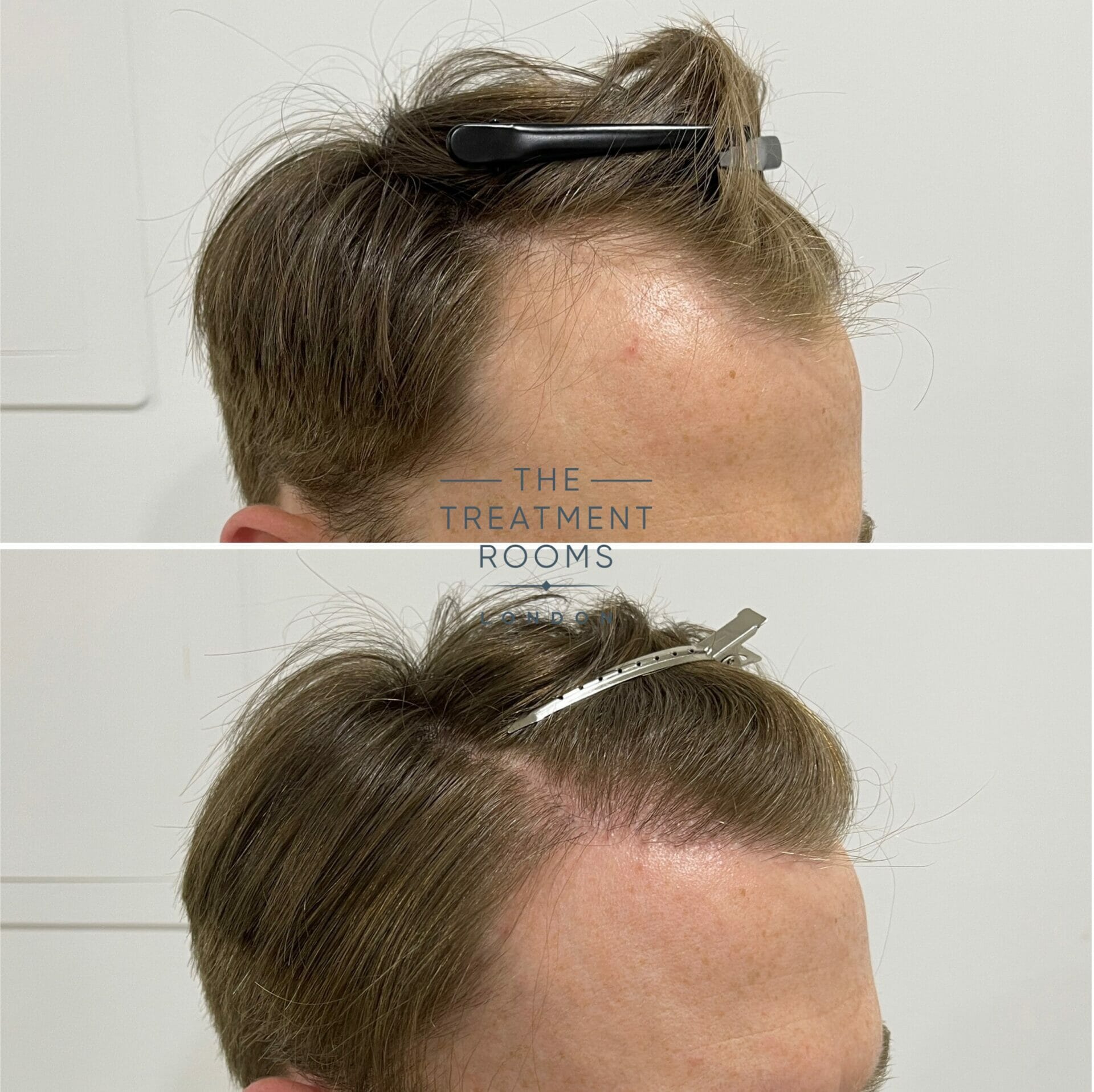 norwood 3 fue hair transplant result 1700 grafts